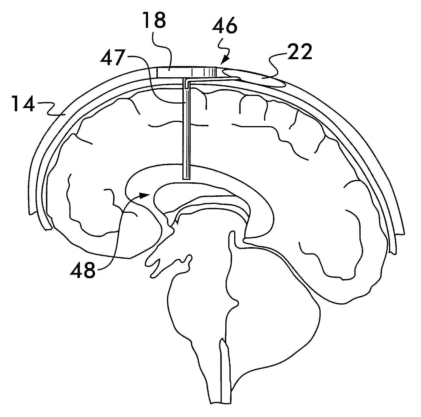 Intracranial pressure sensor