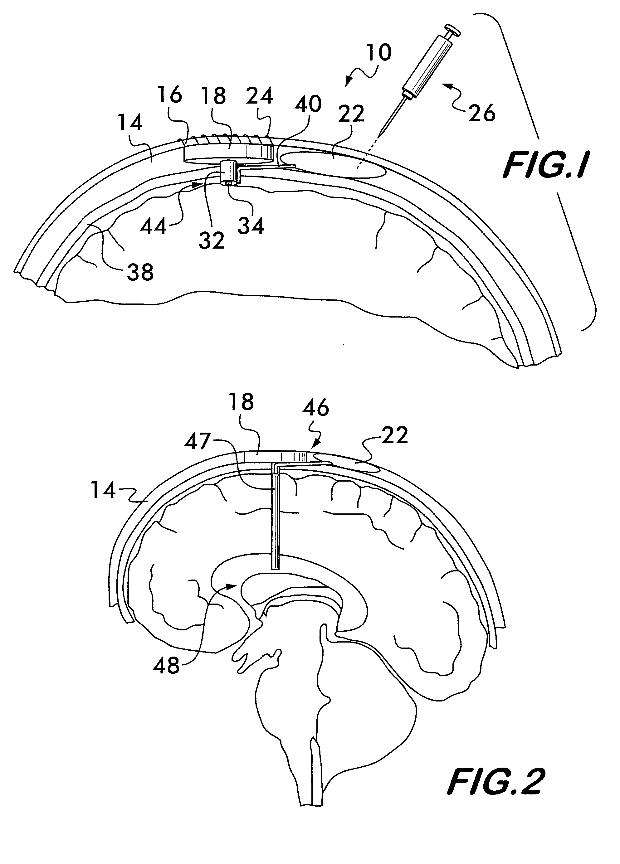 Intracranial pressure sensor