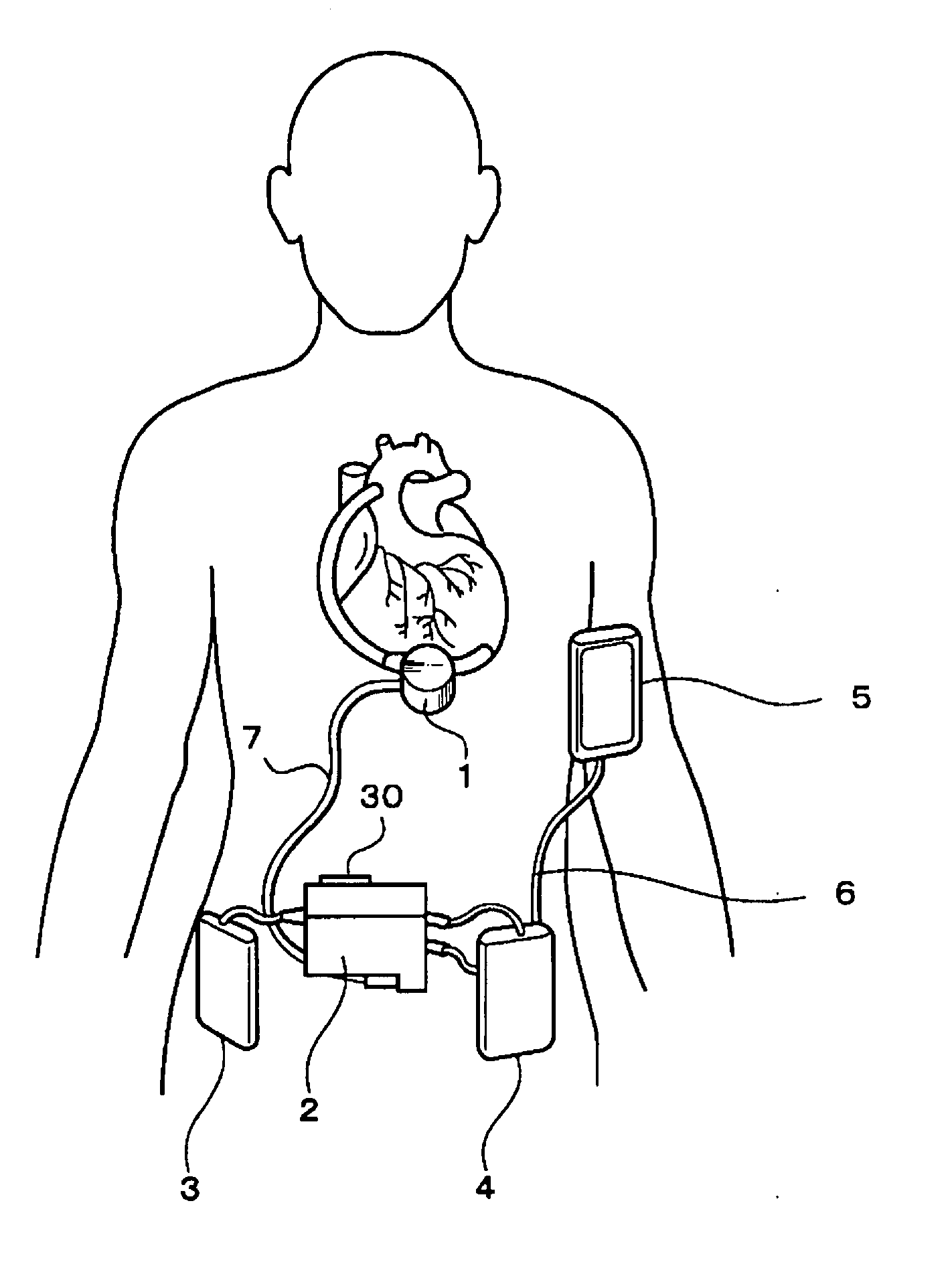 Blood pump system for artificial heart and apparatus supervisory system