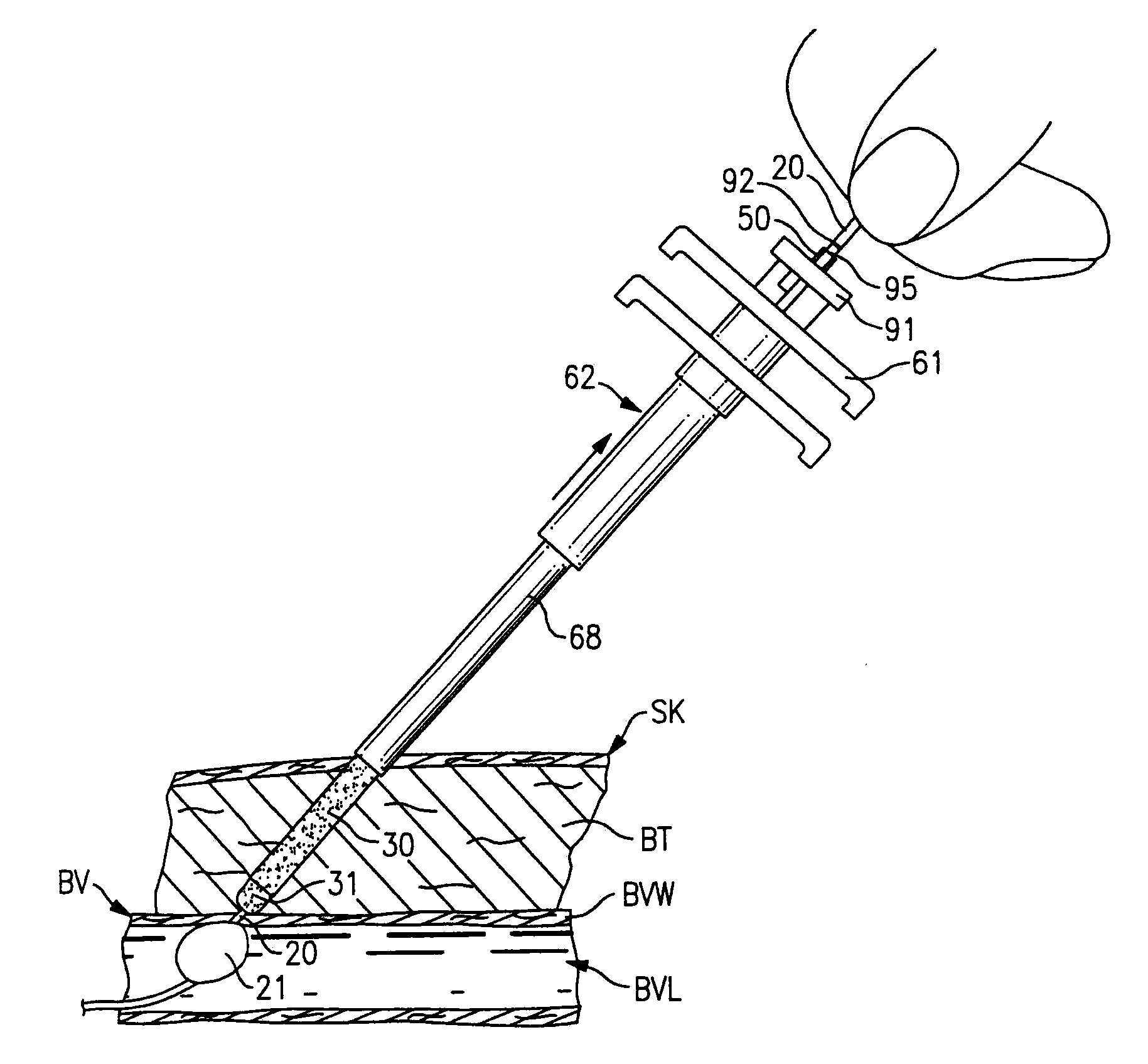 Percutaneous Puncture Sealing System