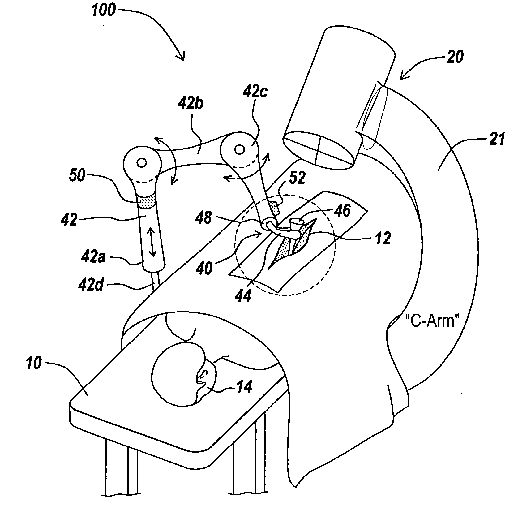 Rigidly guided implant placement with control assist