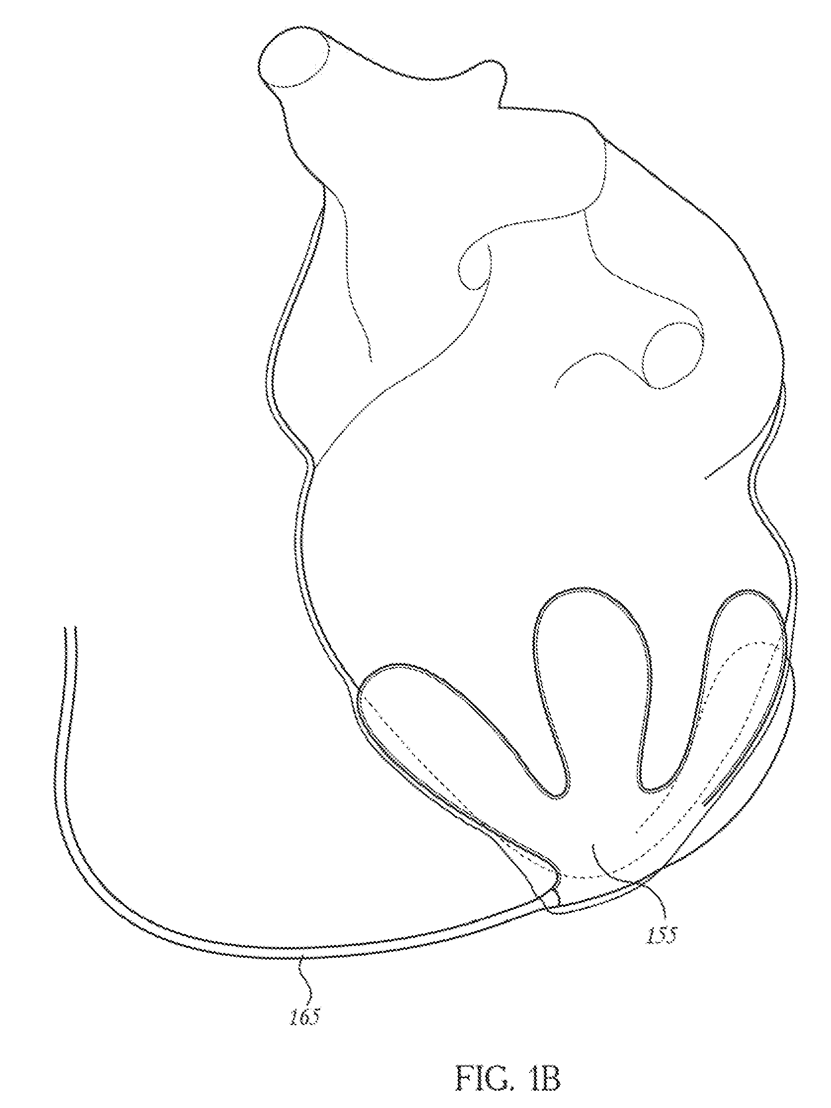 Methods of using pericardial inserts