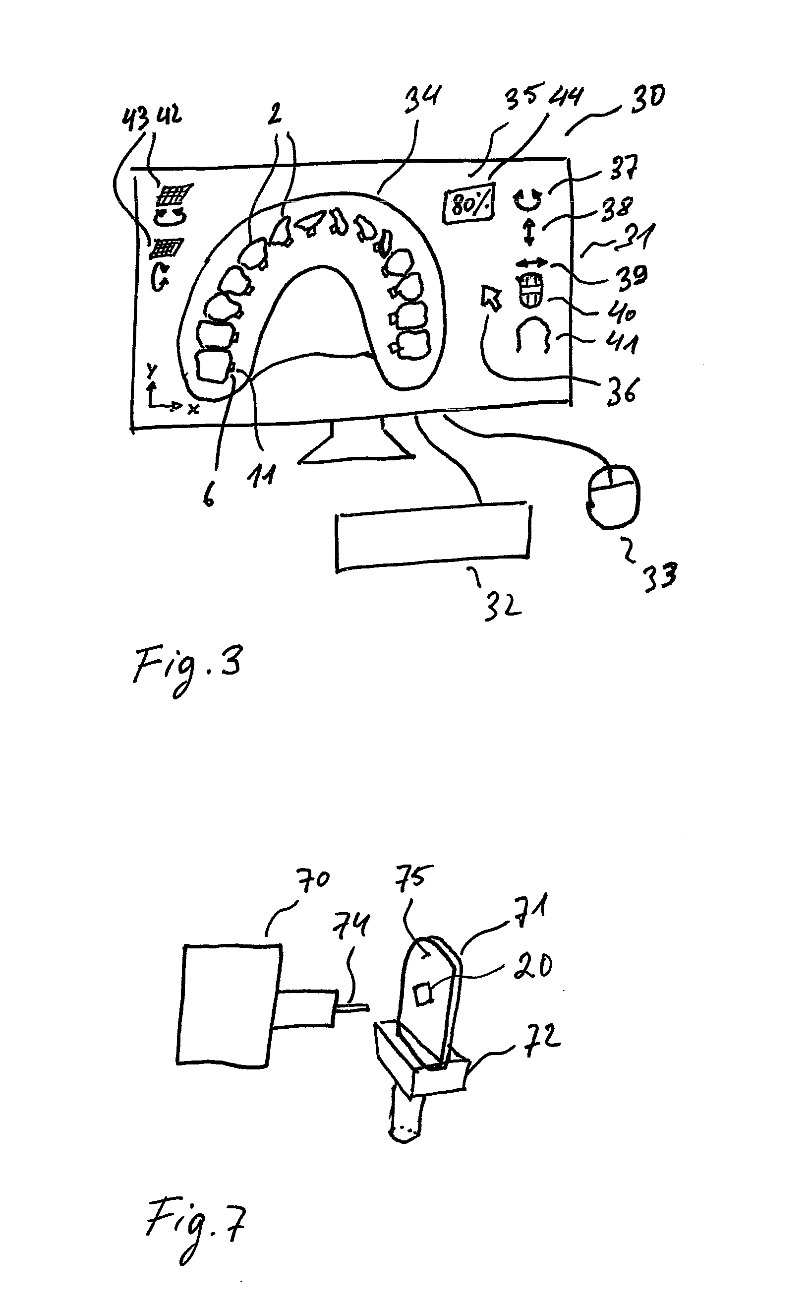 Bracket system and method for planning and producing a bracket system for the correction of tooth malpositions