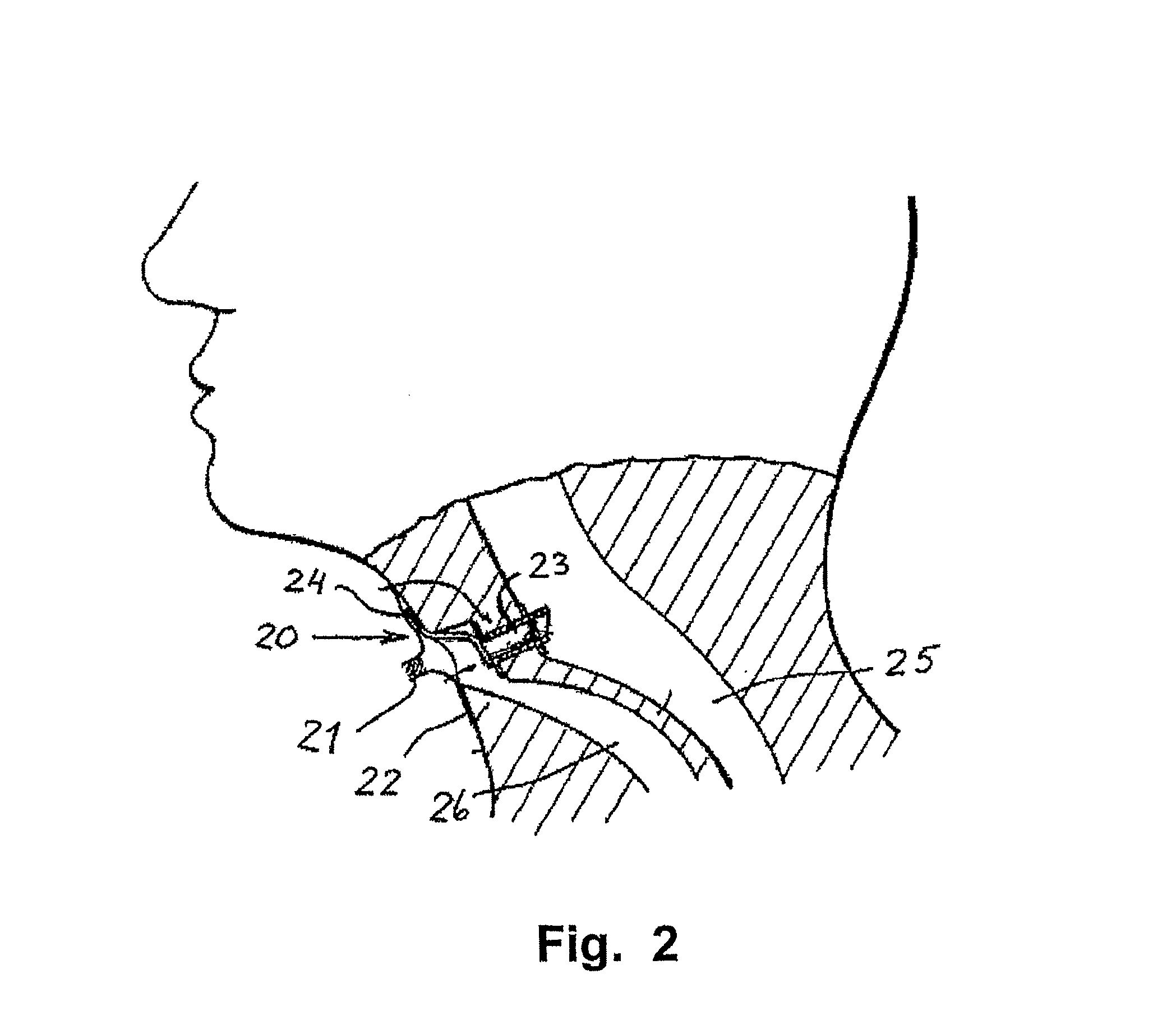 Voice prosthesis, insertion tool and method