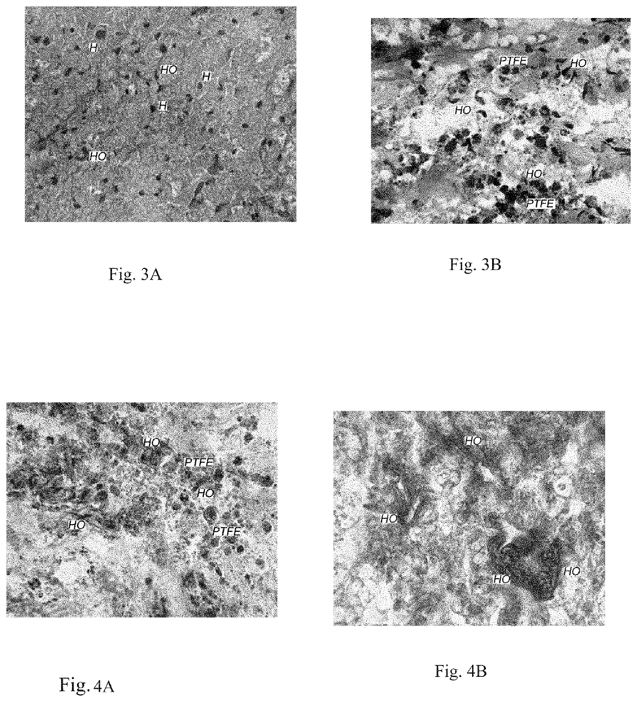 Implant for Injured Nerve Tissue Prosthetics, Method of Surgical Treatment for Injured Nerve Tissue and Use of Porous Polytetrafluorethylene