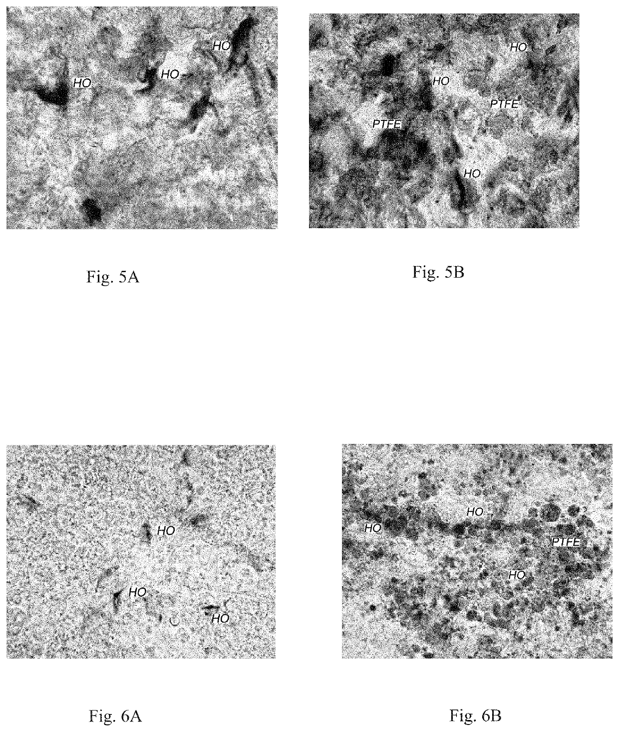 Implant for Injured Nerve Tissue Prosthetics, Method of Surgical Treatment for Injured Nerve Tissue and Use of Porous Polytetrafluorethylene