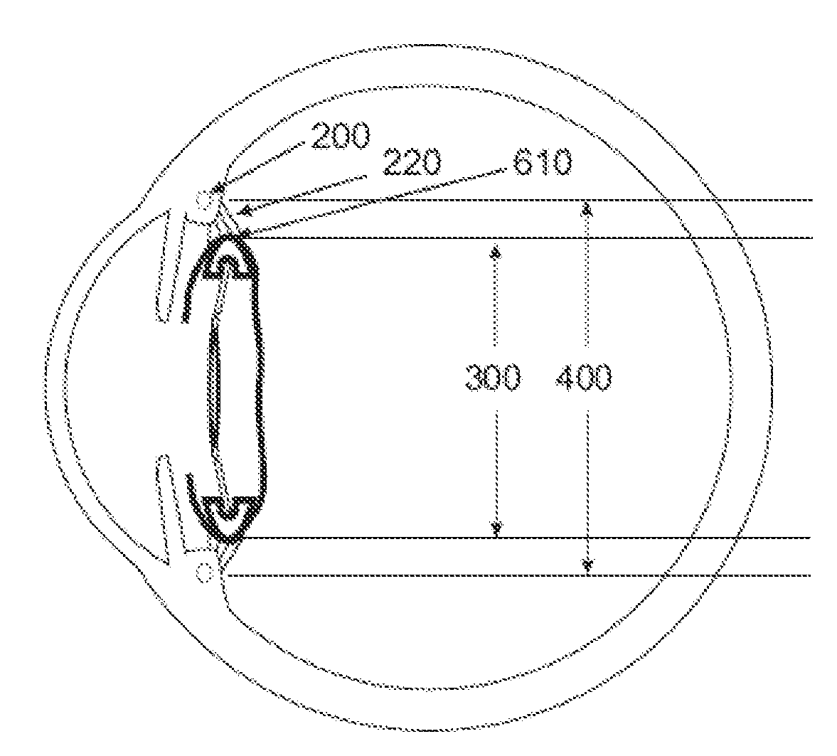 Intraocular Device to Restore Natural Capsular Tension after Cataract Surgery