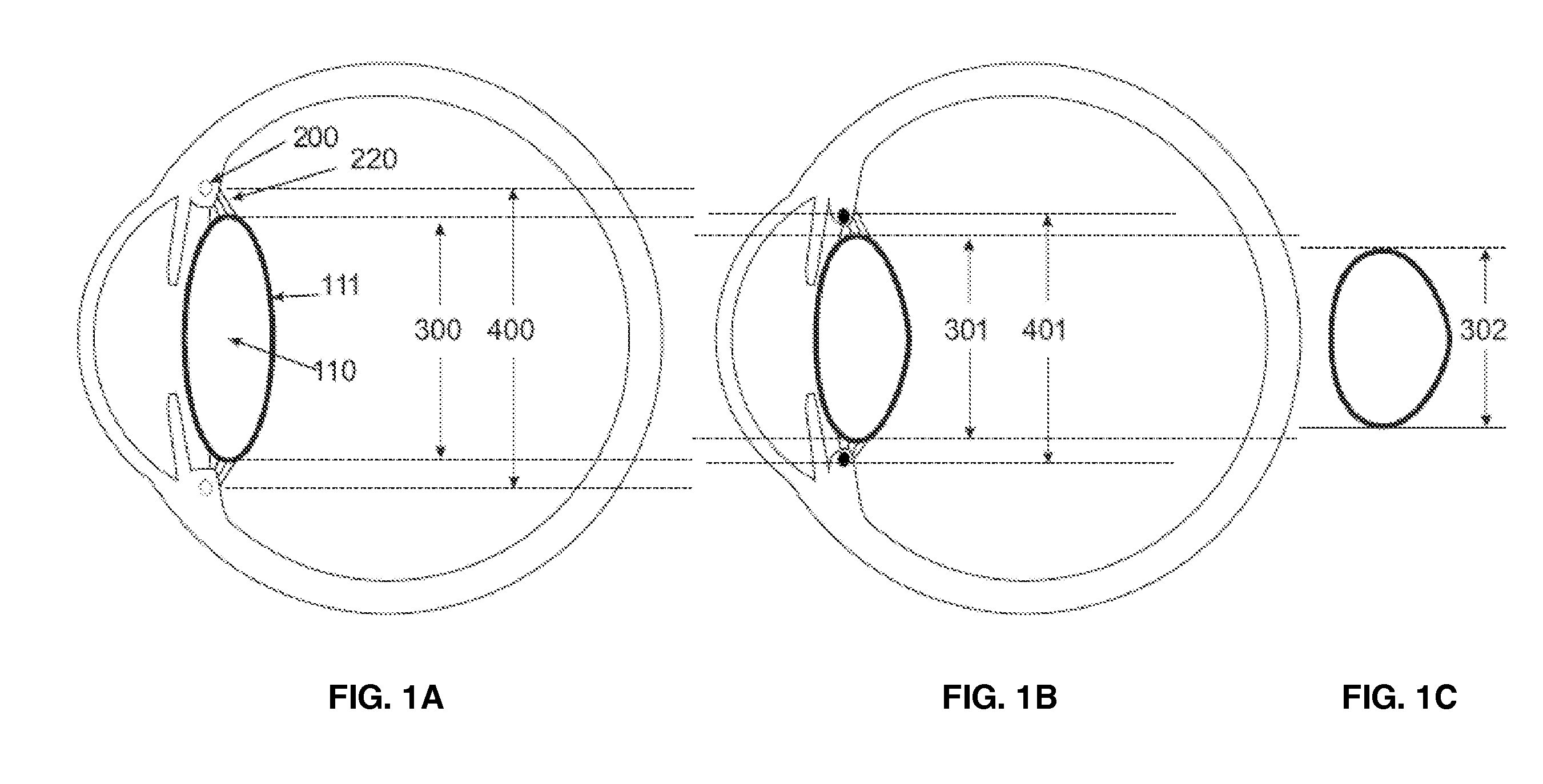 Intraocular Device to Restore Natural Capsular Tension after Cataract Surgery