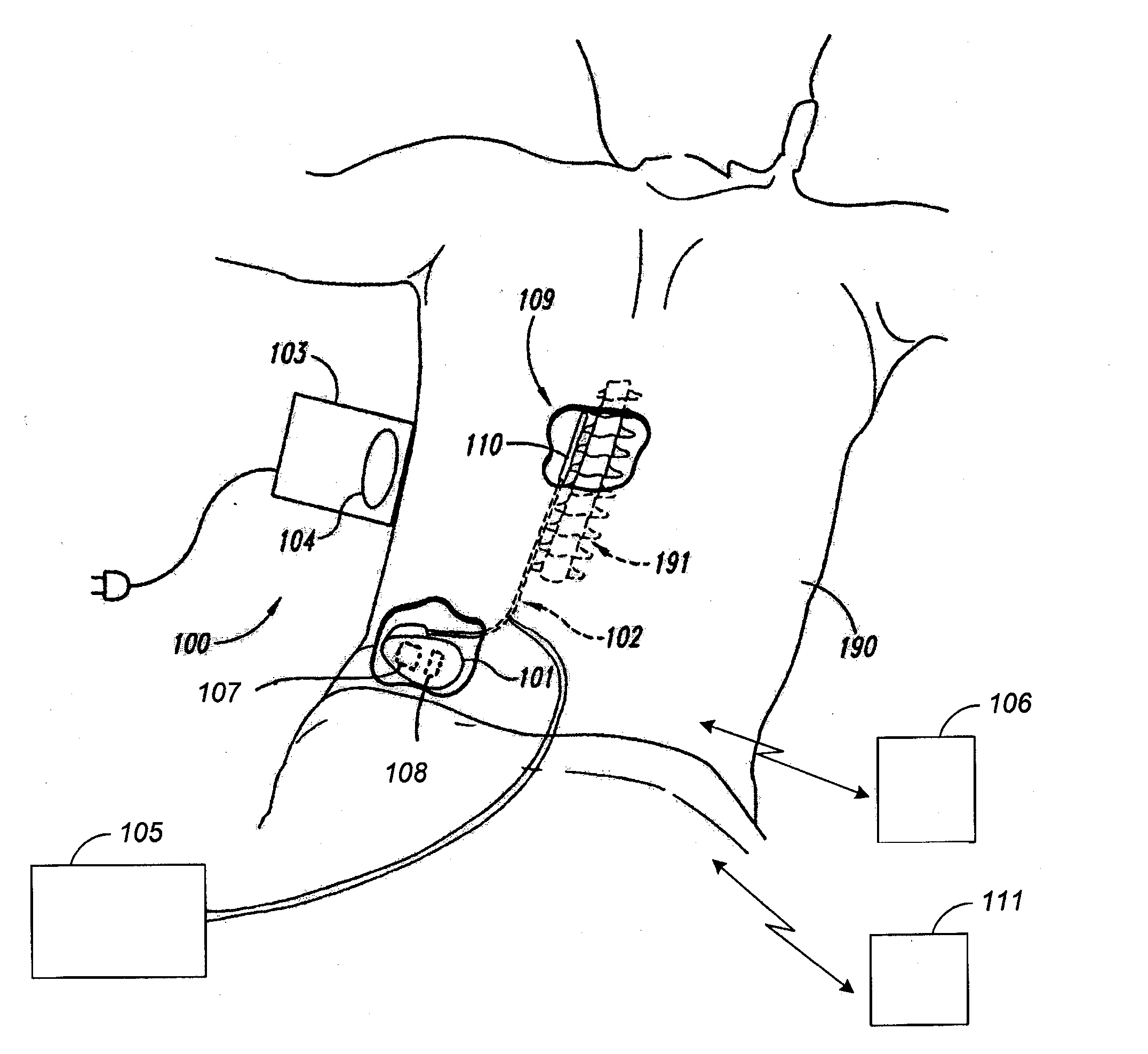 Systems and methods for adjusting electrical therapy based on impedance changes