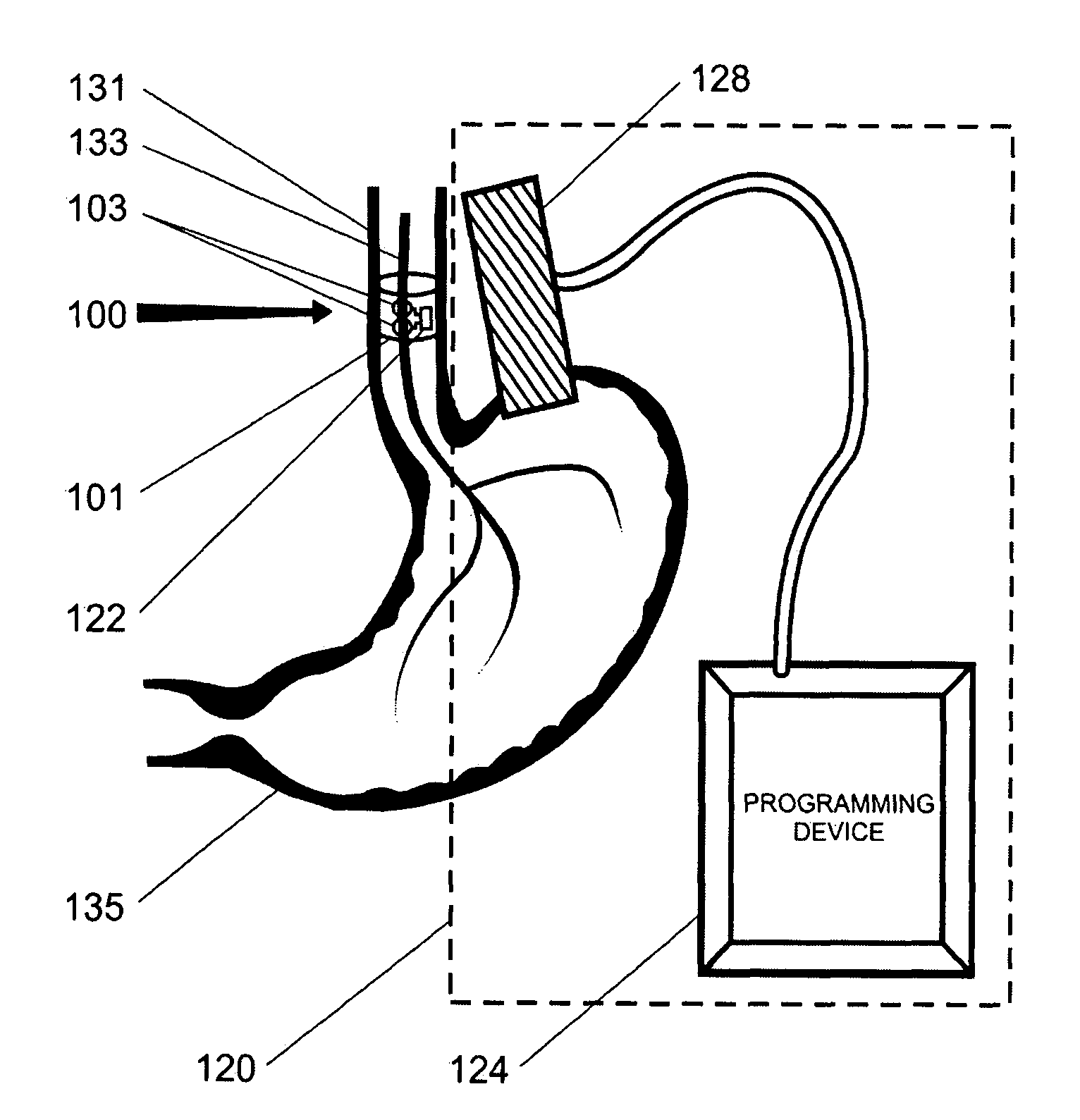 Trans-esophageal vagus nerve stimulation