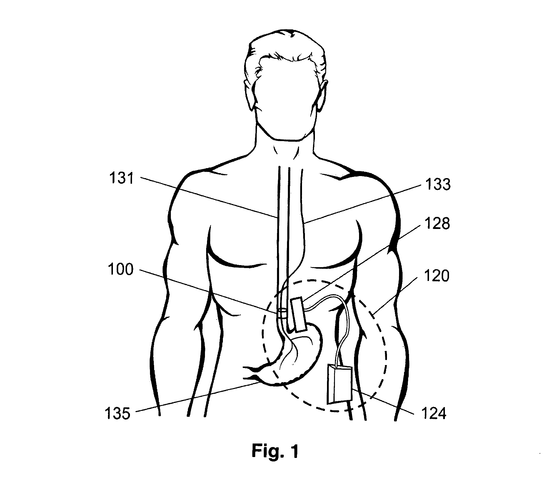 Trans-esophageal vagus nerve stimulation