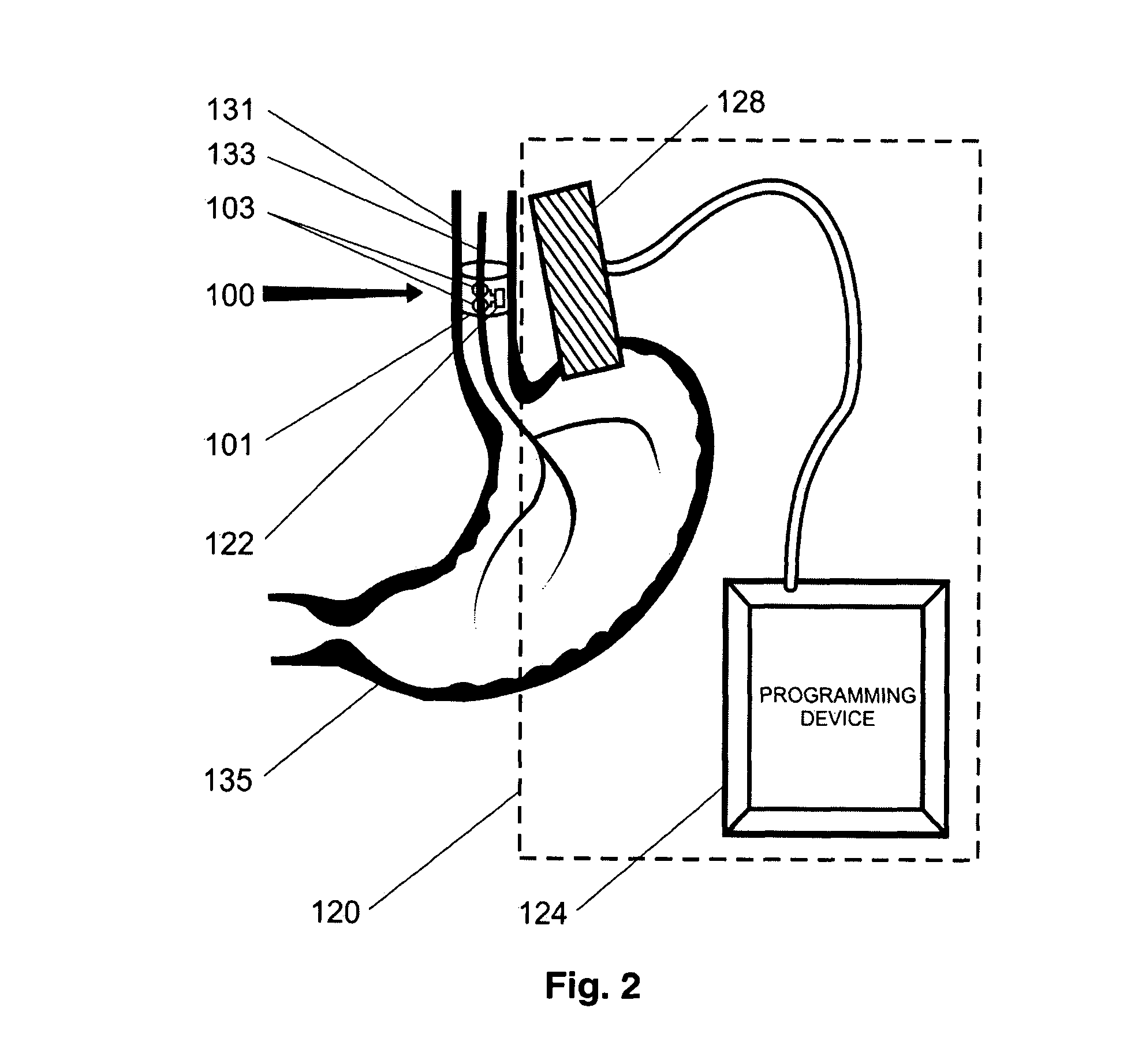 Trans-esophageal vagus nerve stimulation