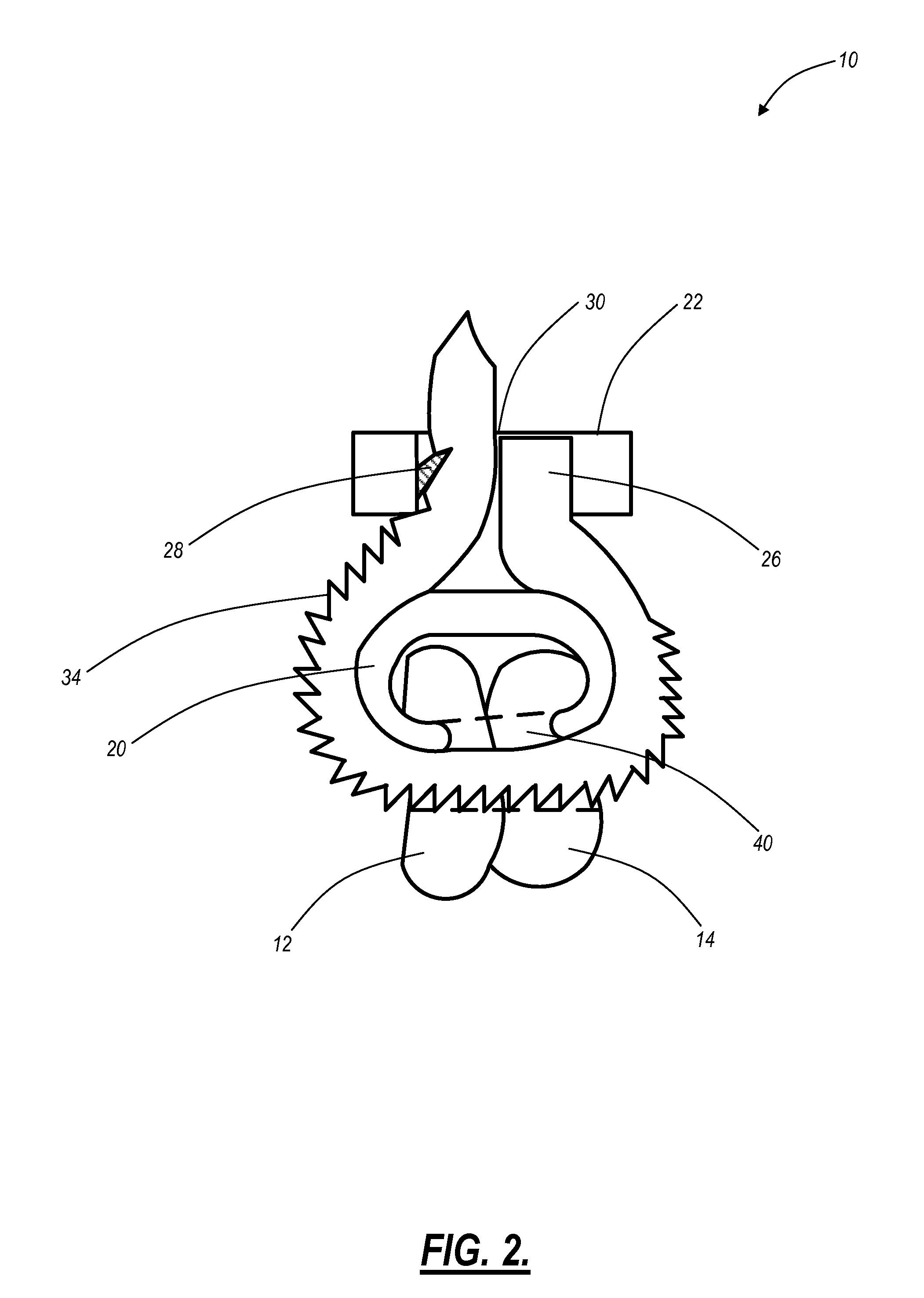 Surgical systems and methods for joint fixation