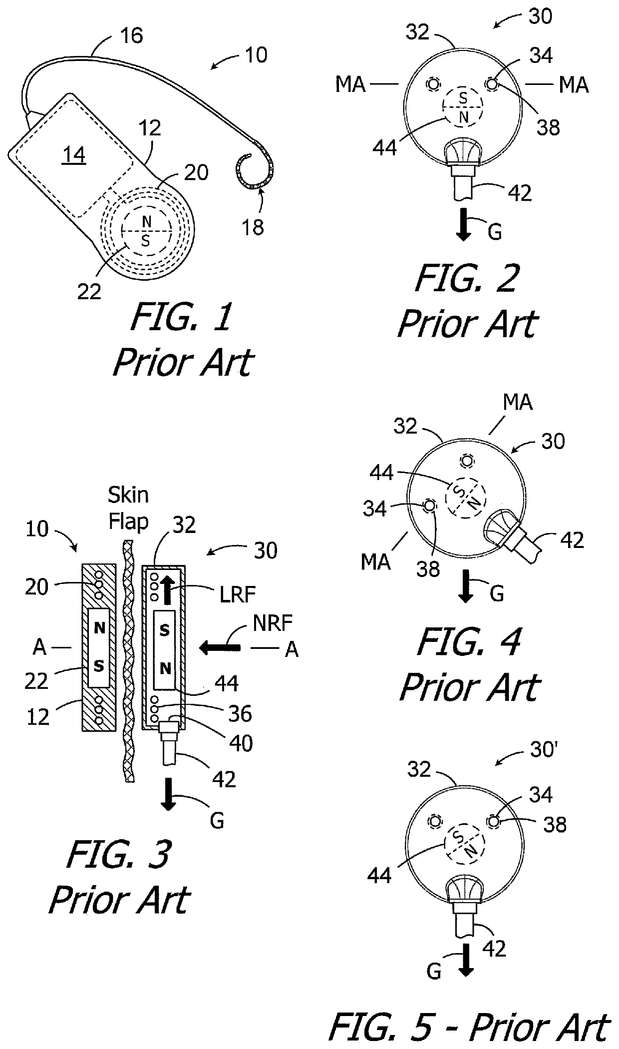 Headpieces and implantable cochlear stimulation systems including the same