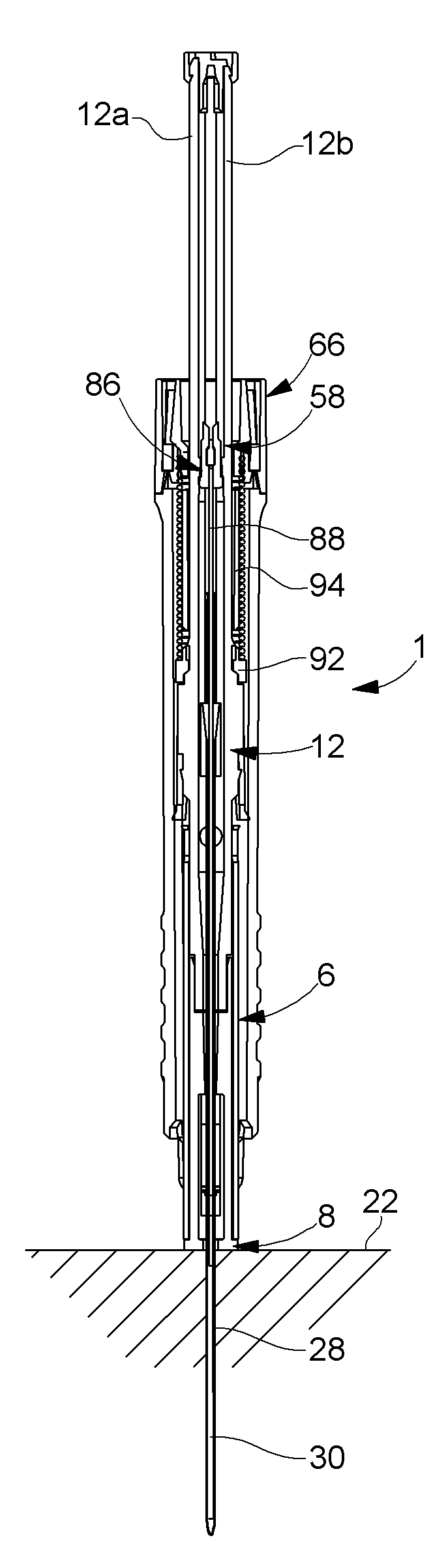 Implant back-injecting device