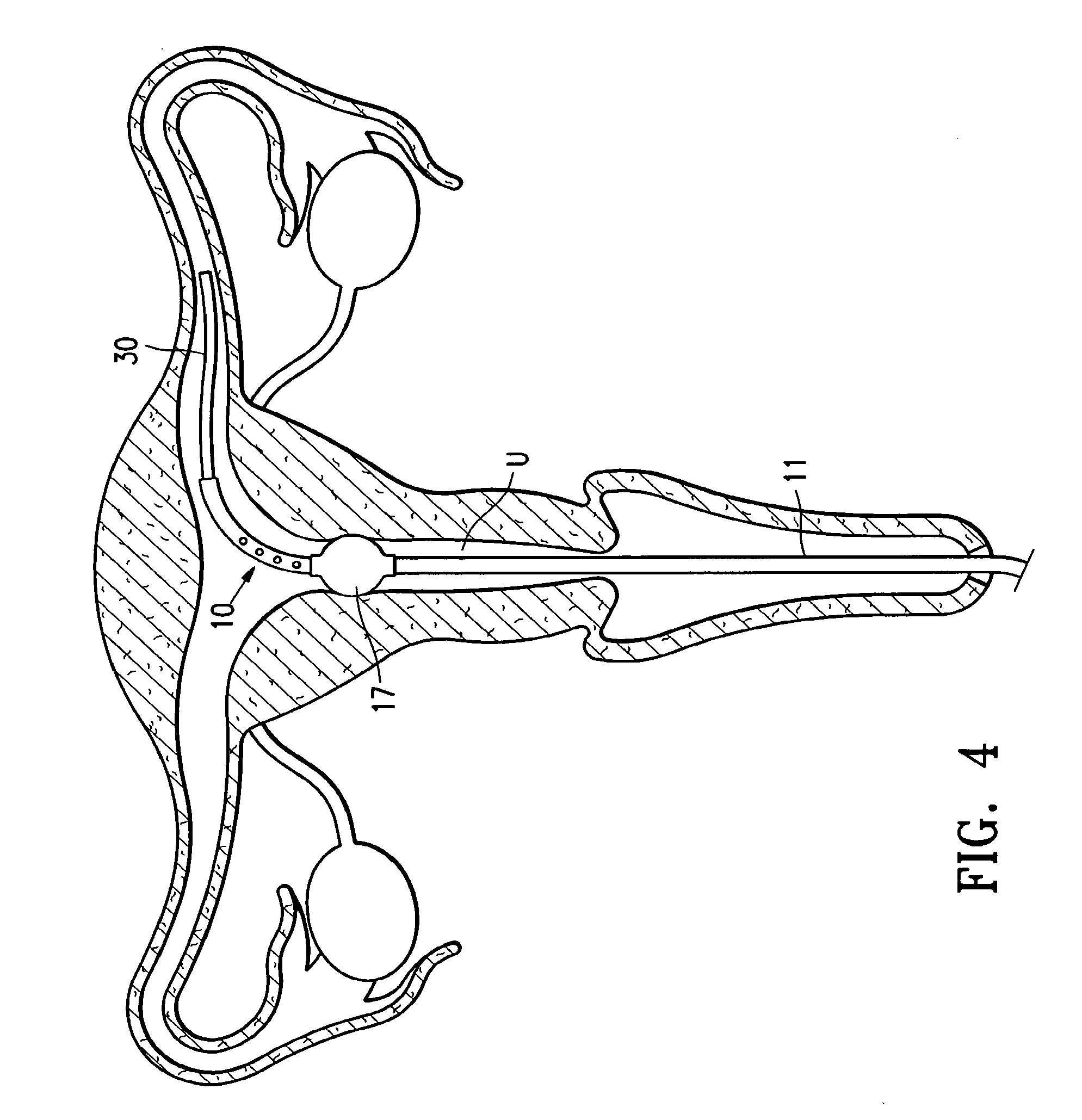 Endoscopic delivery of medical devices