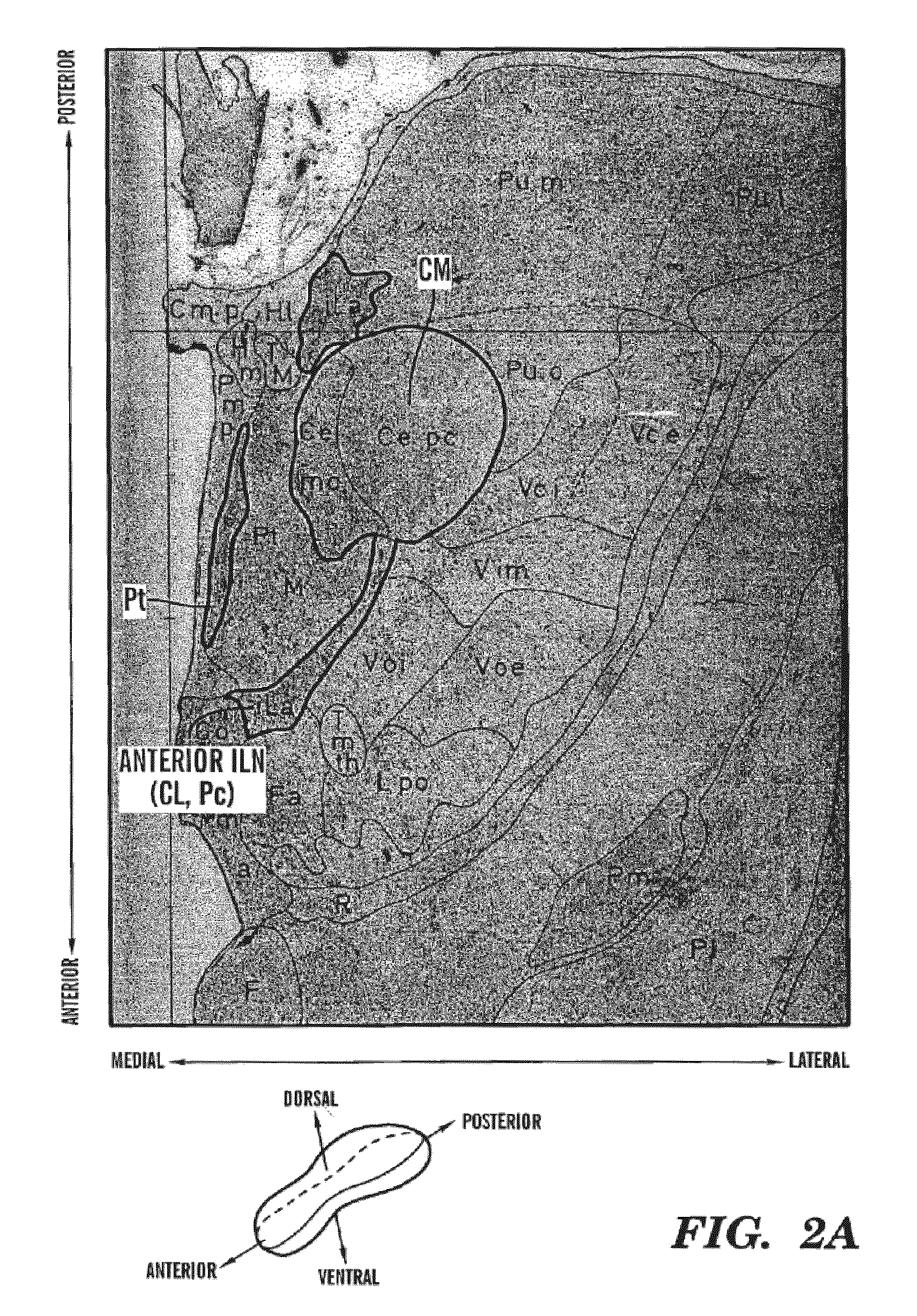 Feedback method for deep brain stimulation with detection of generalized efference copy signals