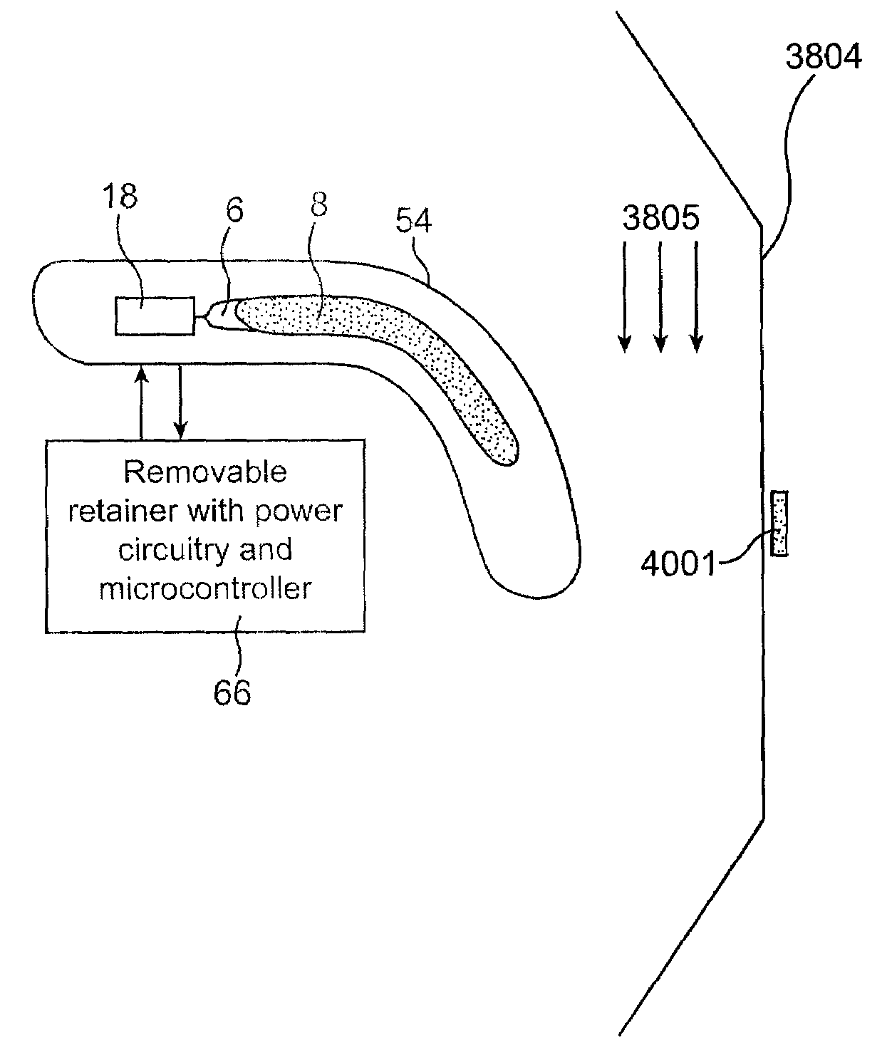 Control system for a tongue stabilization device