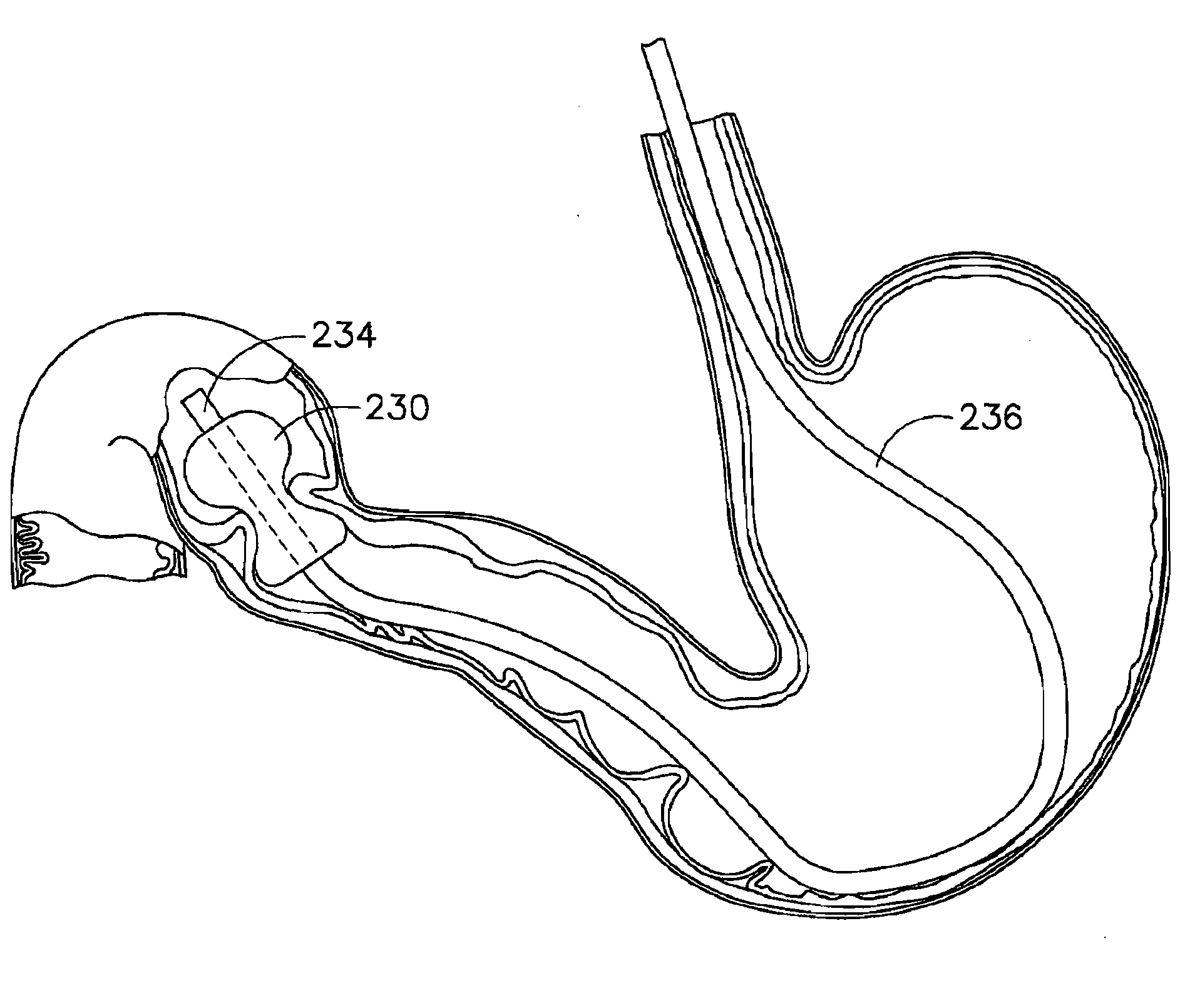 Method of insufflating the interior of a gastric cavity of a patient.