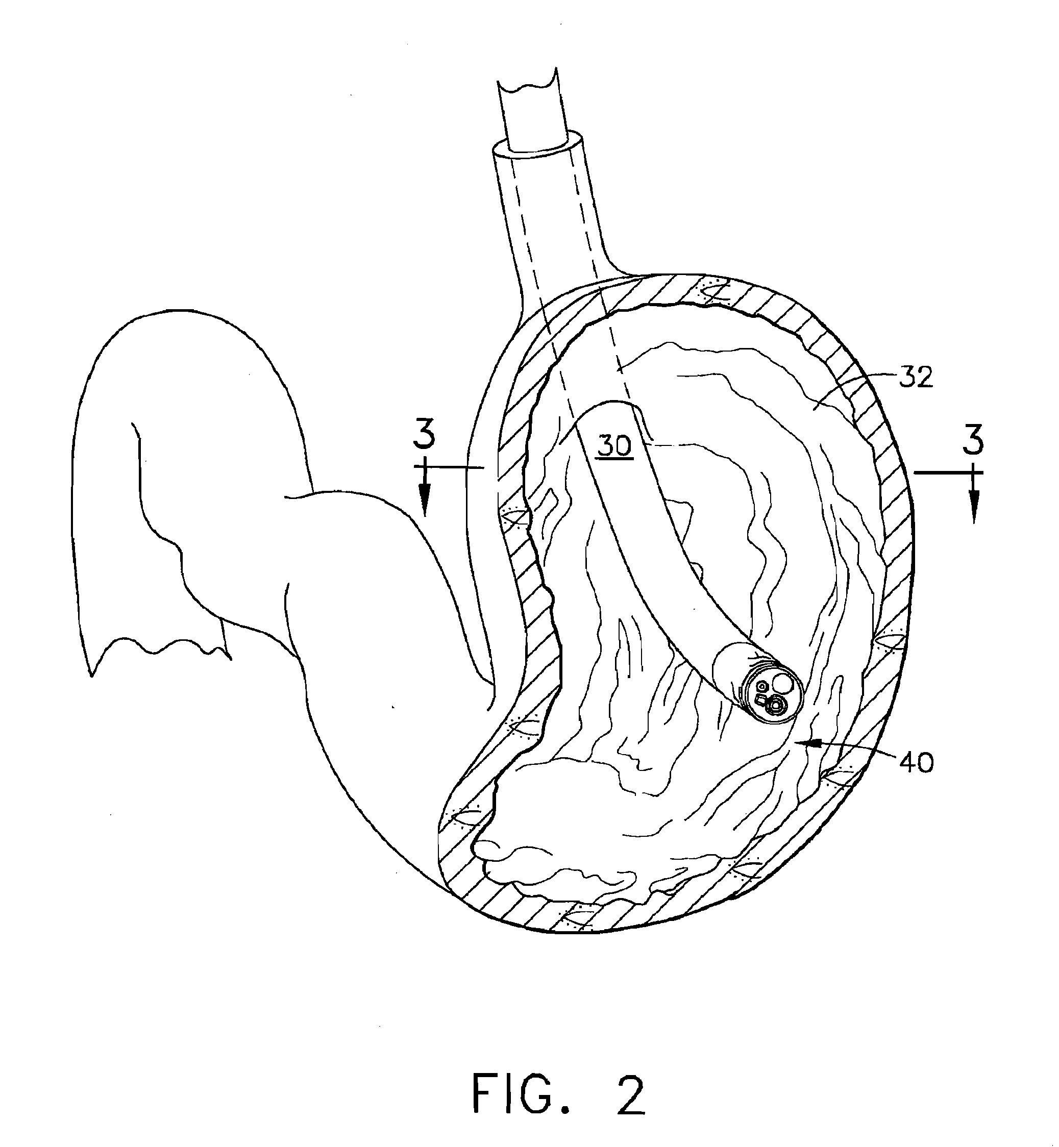 Method of insufflating the interior of a gastric cavity of a patient.