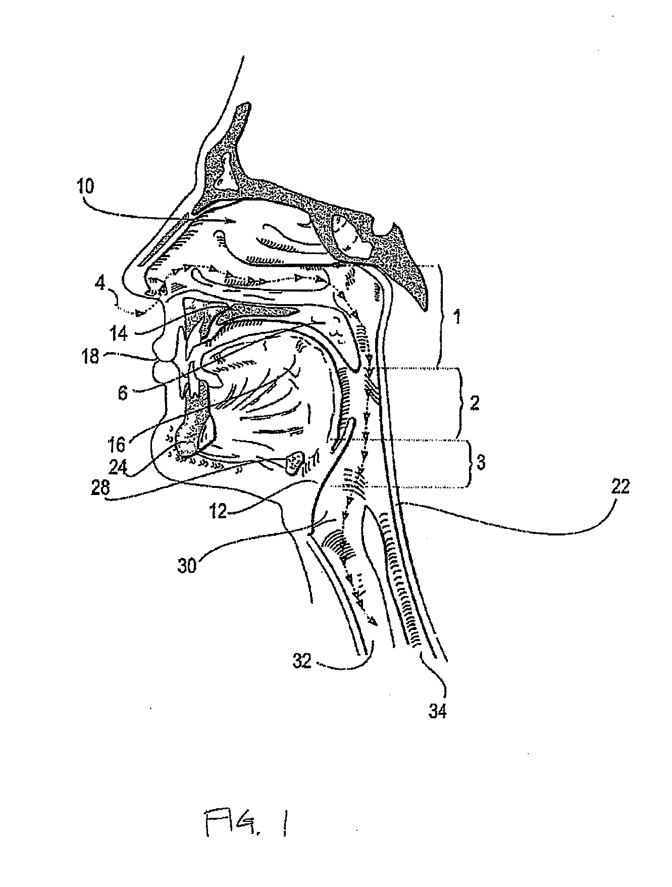 Systems and methods for treatment of sleep apnea