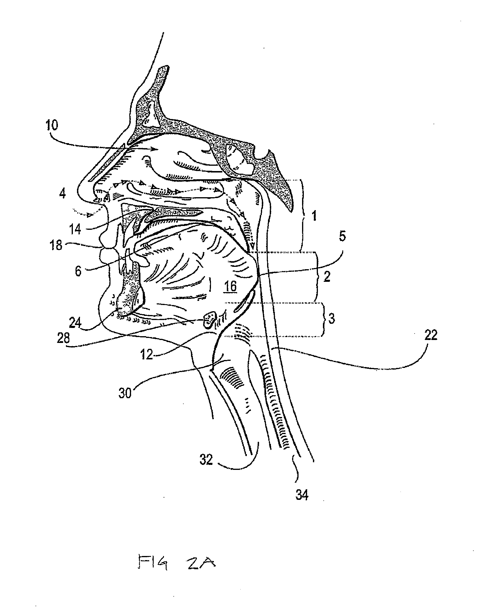 Systems and methods for treatment of sleep apnea