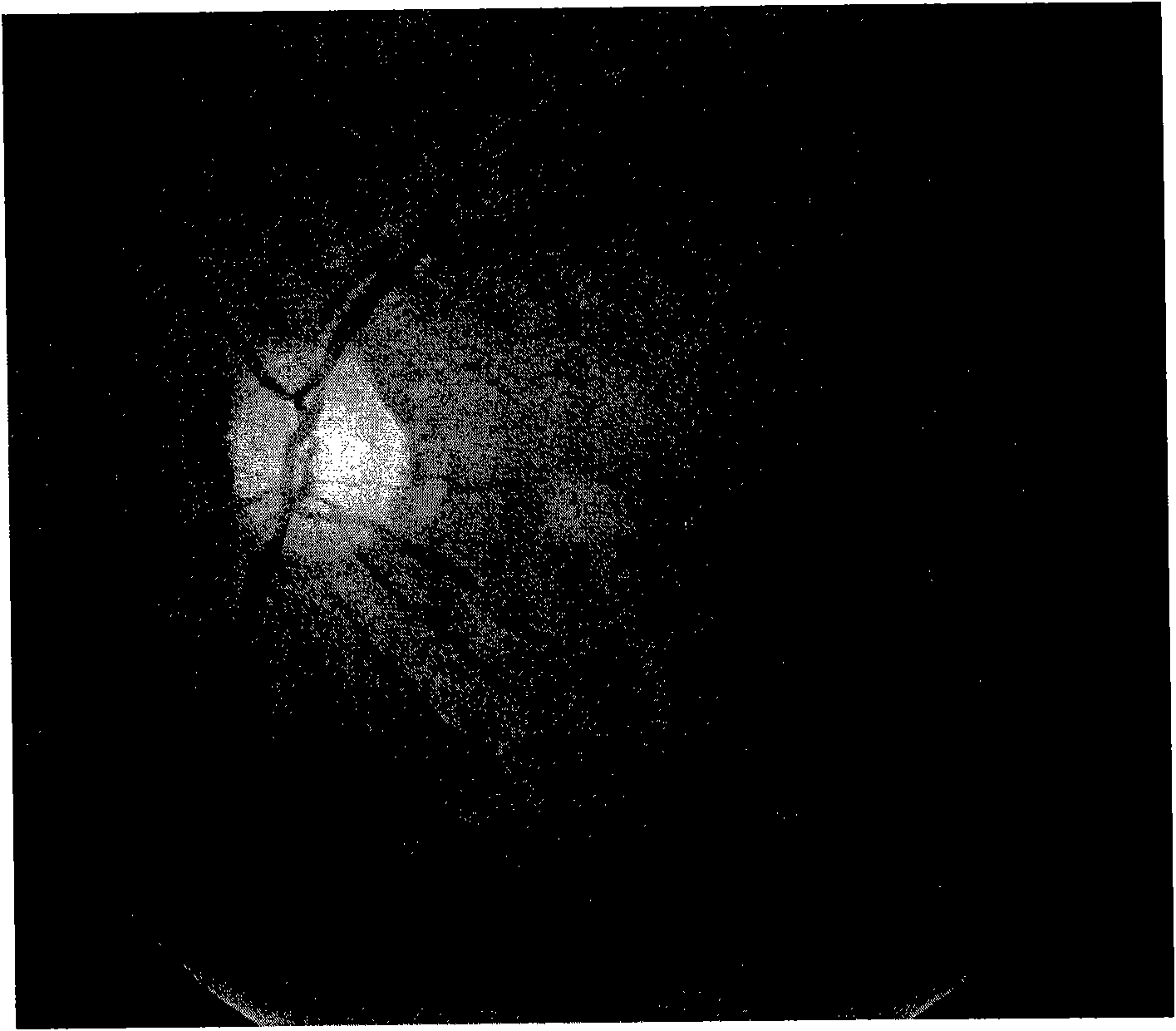 Ocular fundus image registration method estimated based on distance transformation parameter and rigid transformation parameter