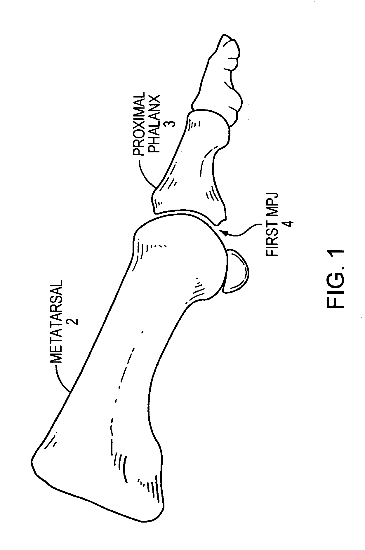 Method and apparatus for manipulating a toe joint