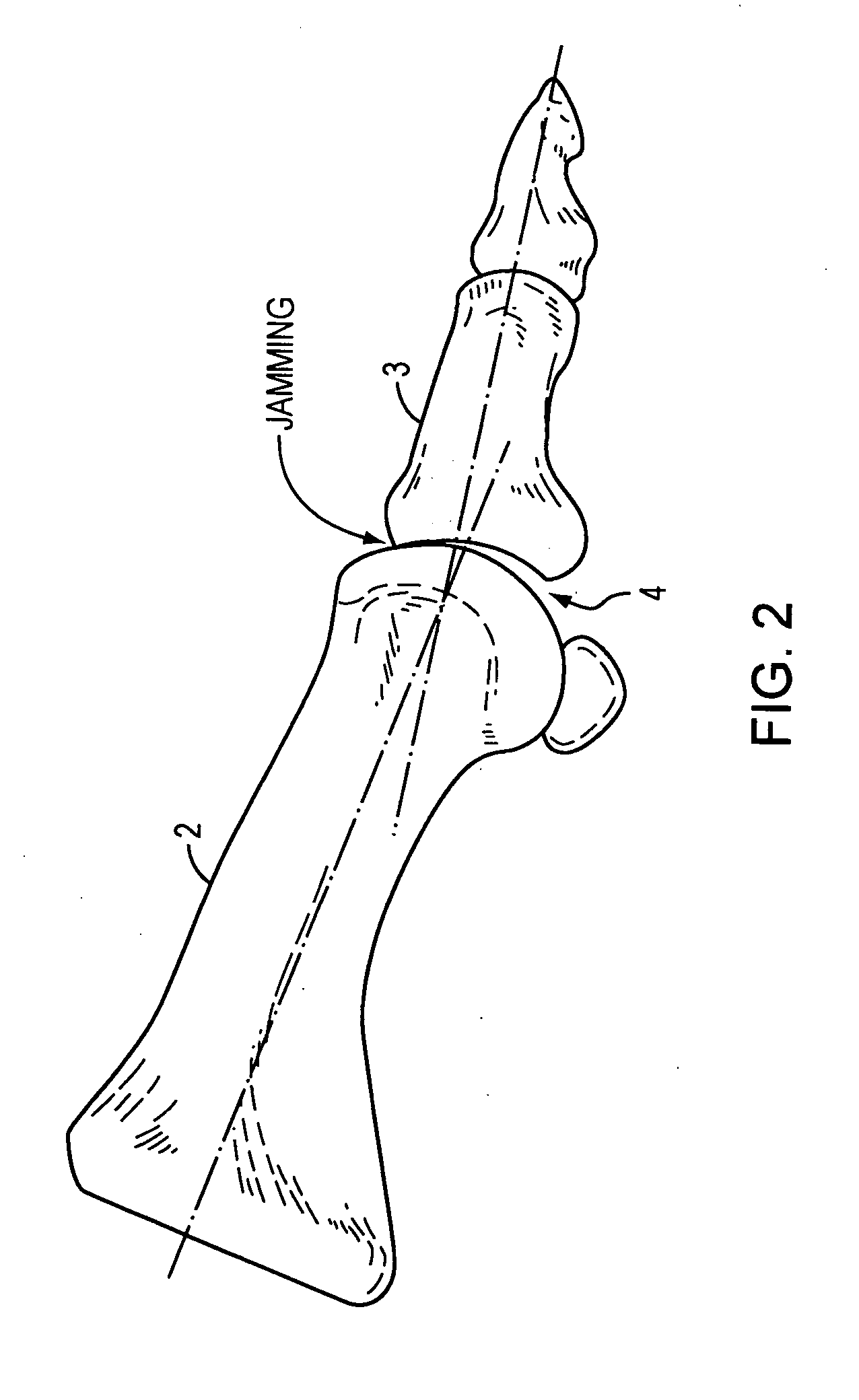 Method and apparatus for manipulating a toe joint