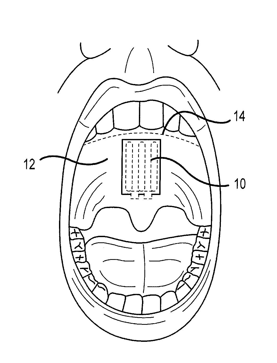 Bioadhesive Strip and Method of Using Same