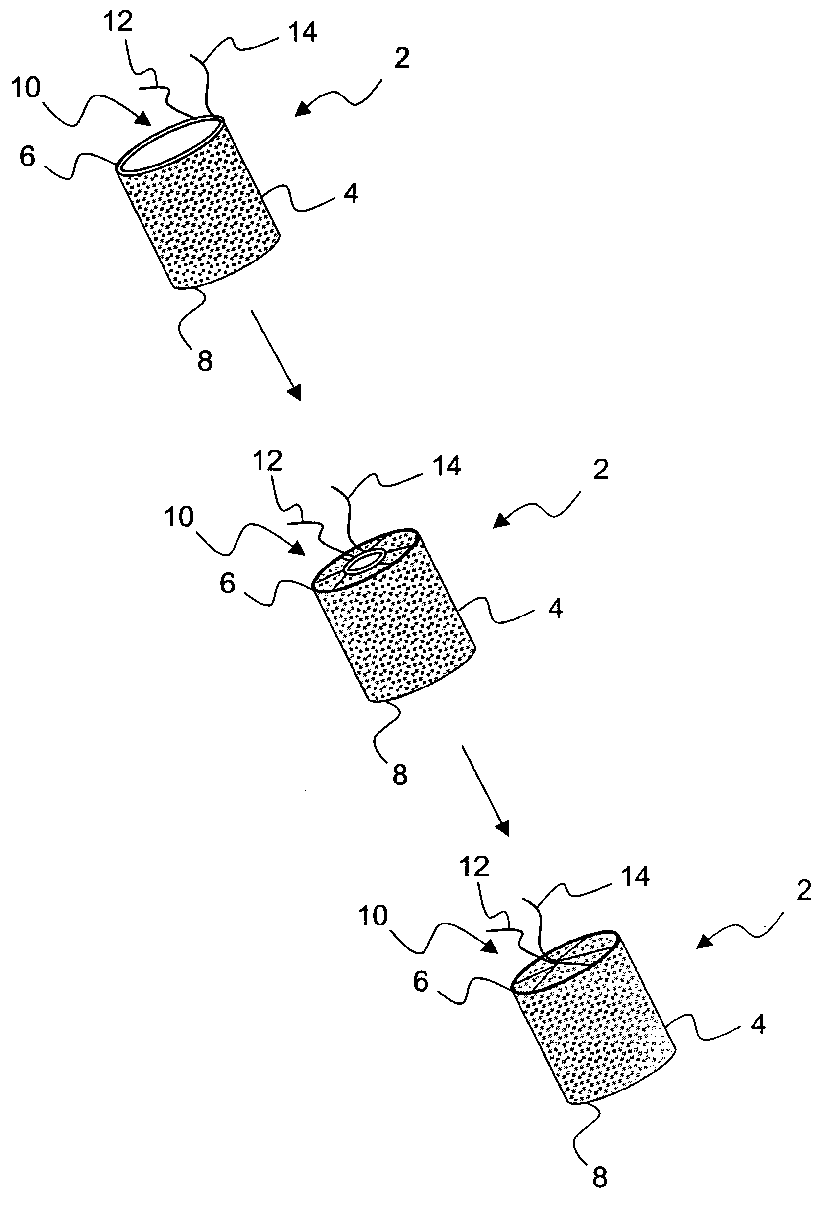 Temporary absorbable venous occlusive stent and superficial vein treatment method