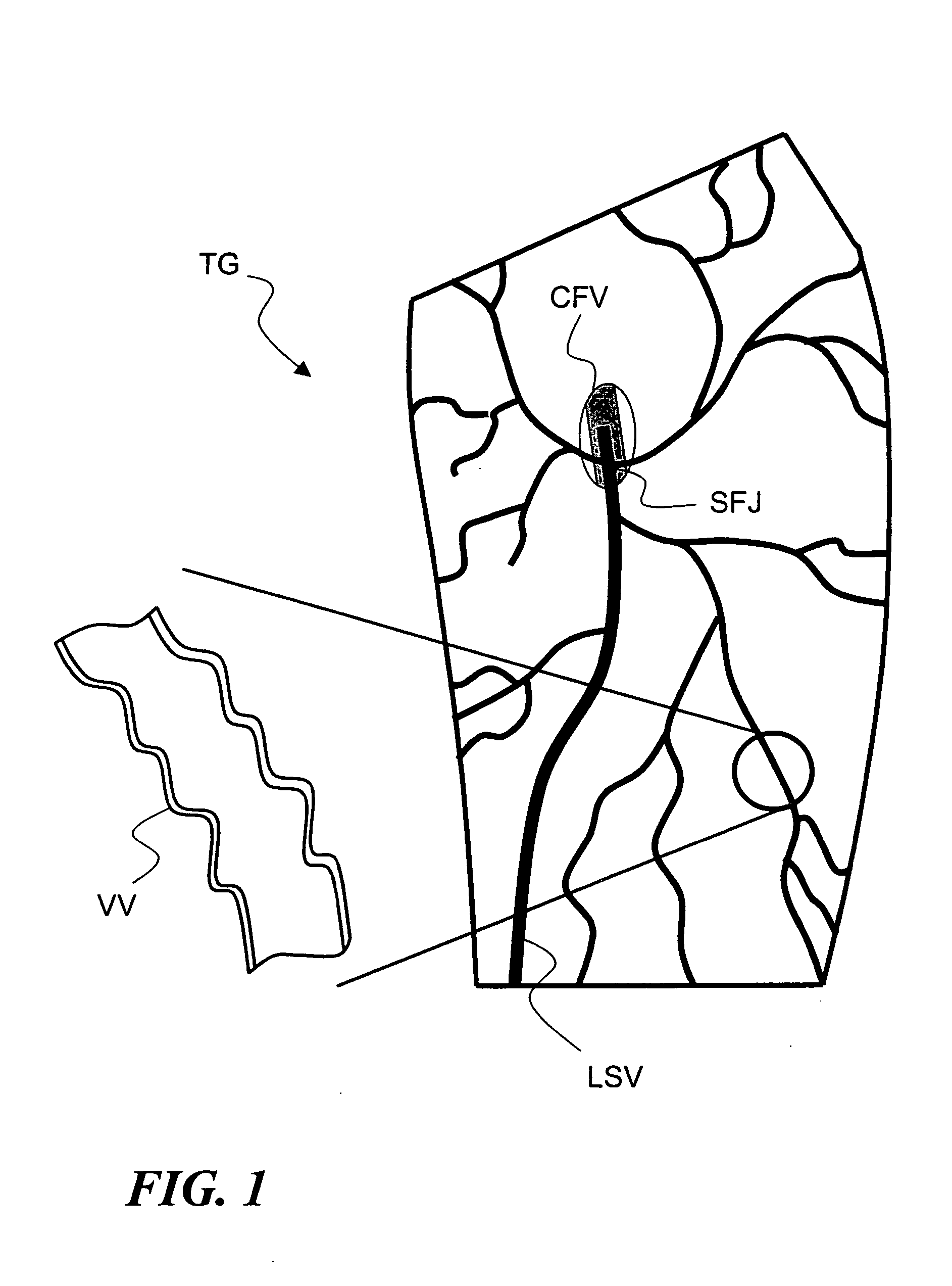 Temporary absorbable venous occlusive stent and superficial vein treatment method