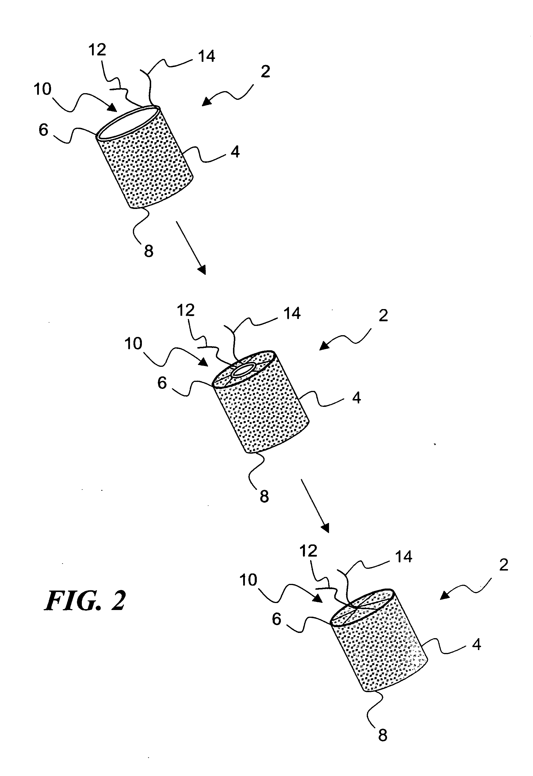 Temporary absorbable venous occlusive stent and superficial vein treatment method