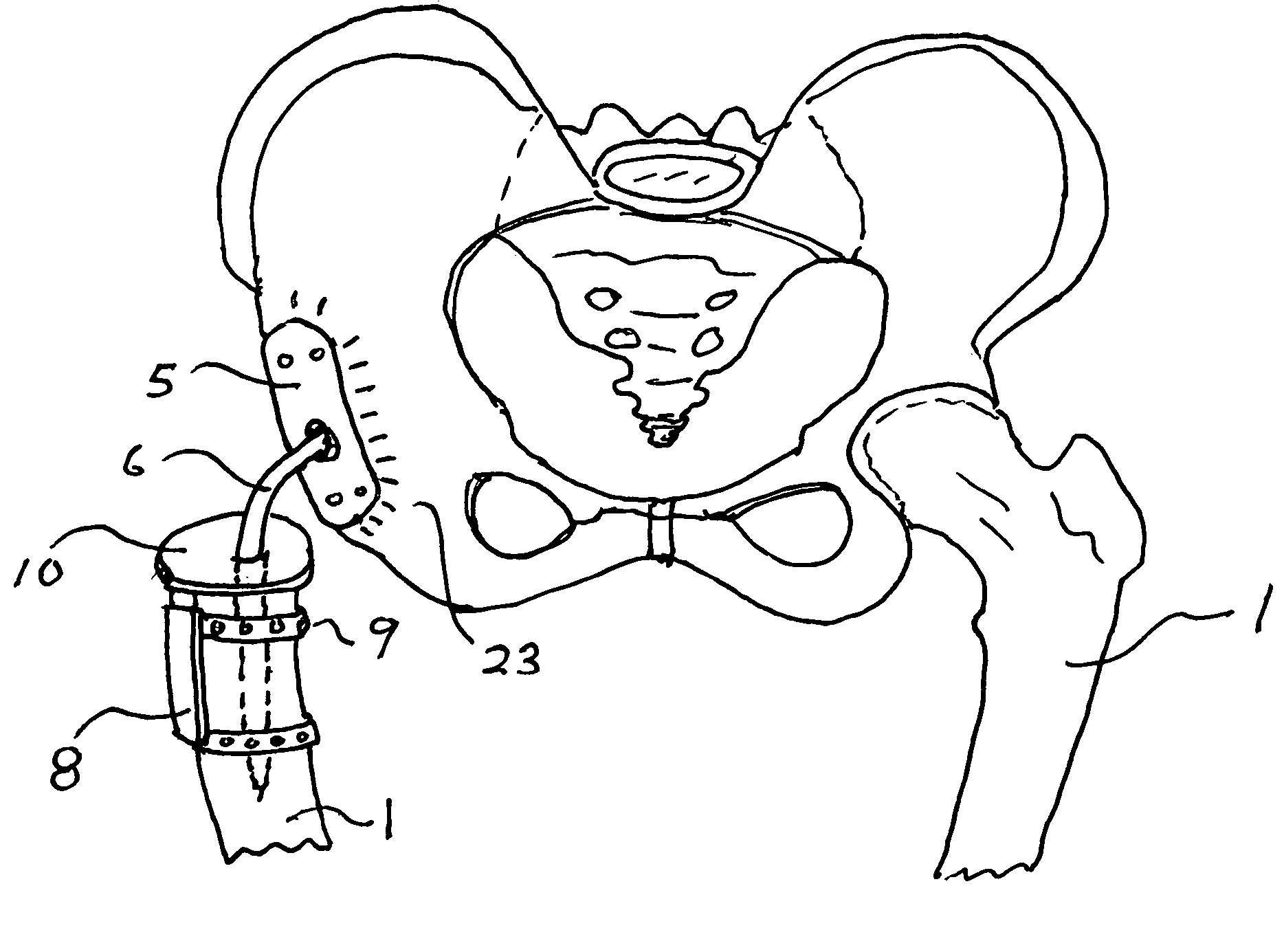 Apparatus for total hip replacement for cases of hip ankylosis and severe joint infection