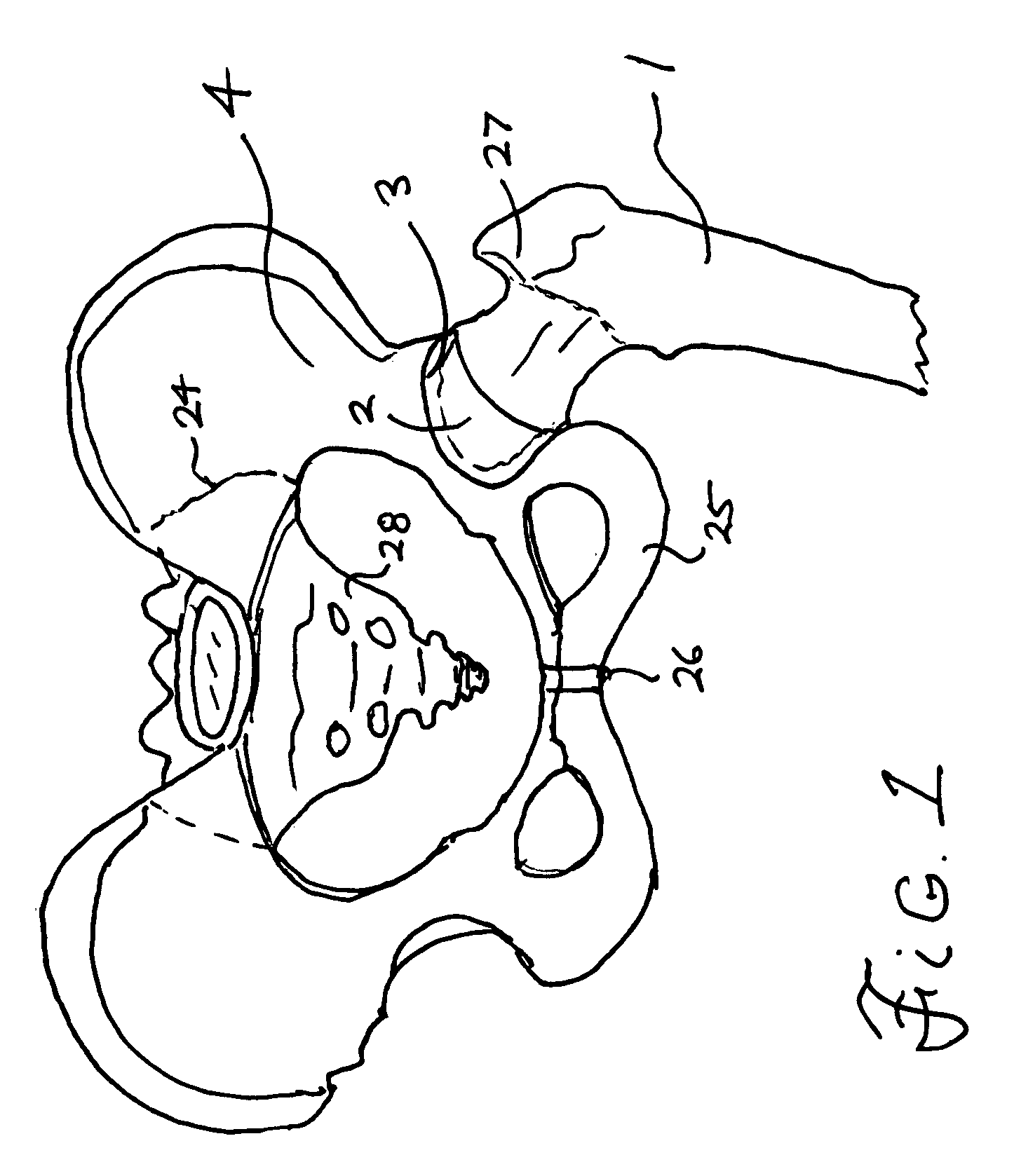 Apparatus for total hip replacement for cases of hip ankylosis and severe joint infection