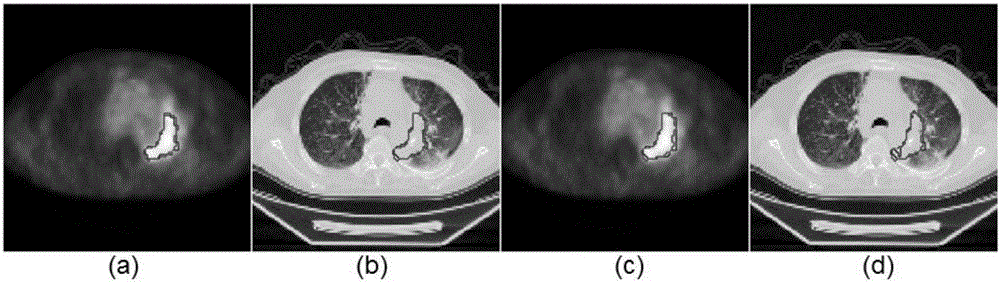 PET-CT lung tumor segmentation method combining three dimensional graph cut algorithm with random walk algorithm