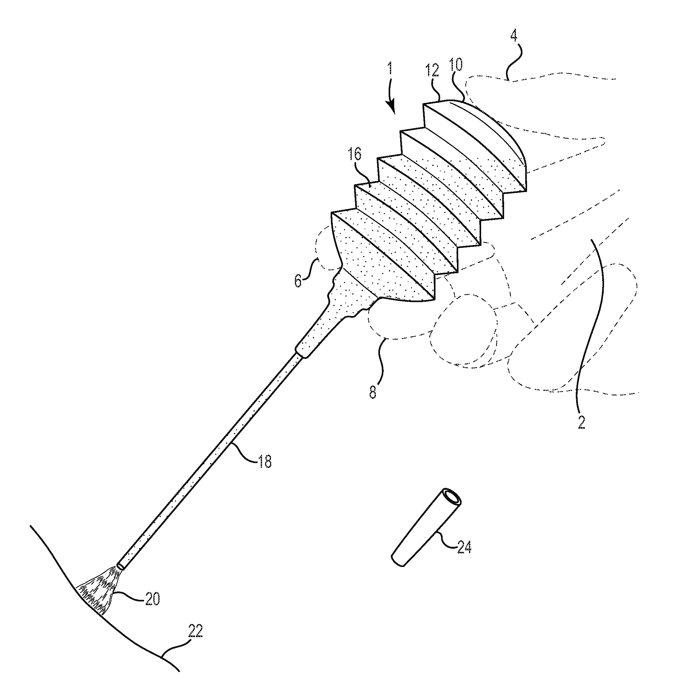 Artificial scab for use in an airway