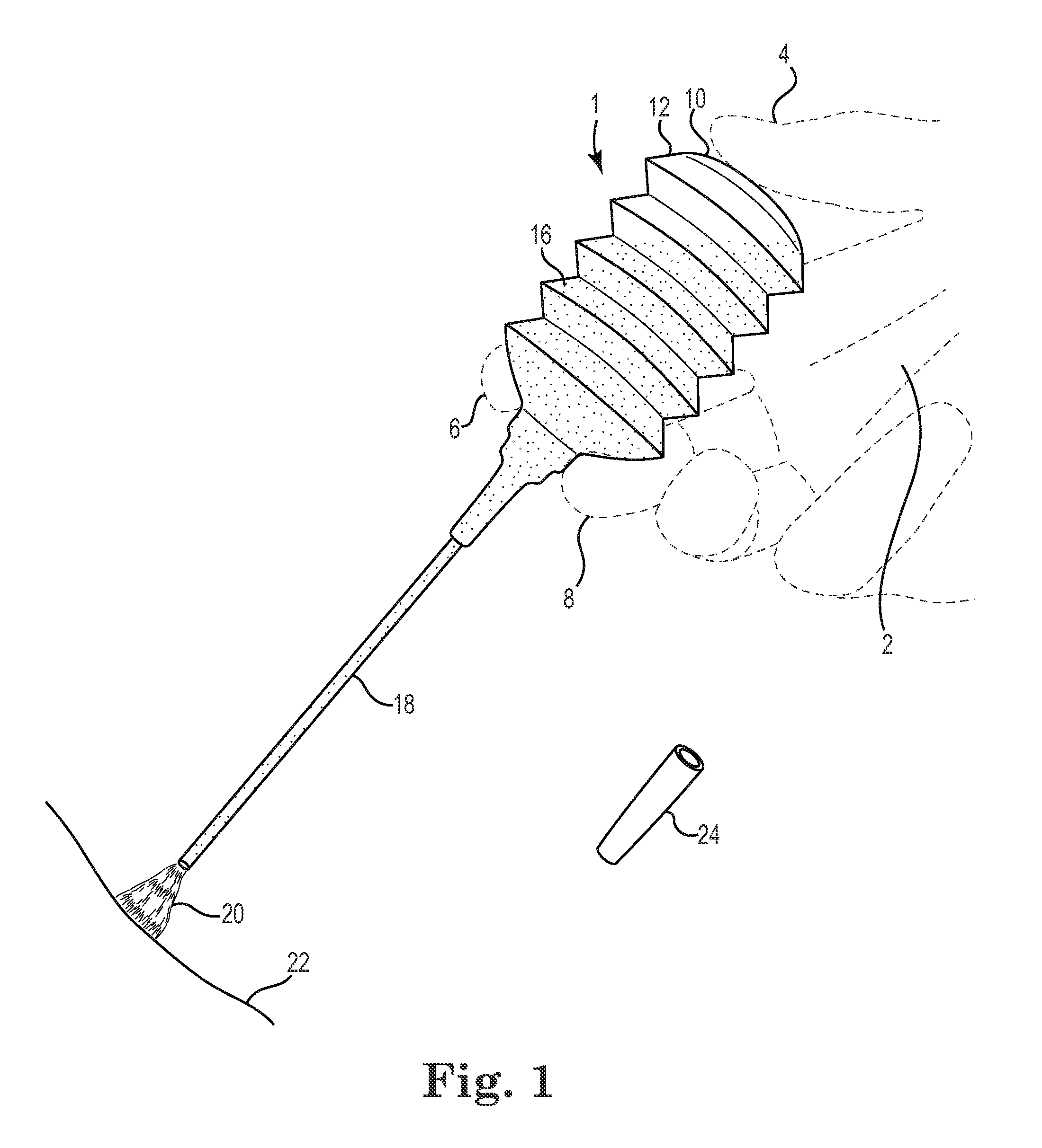 Artificial scab for use in an airway