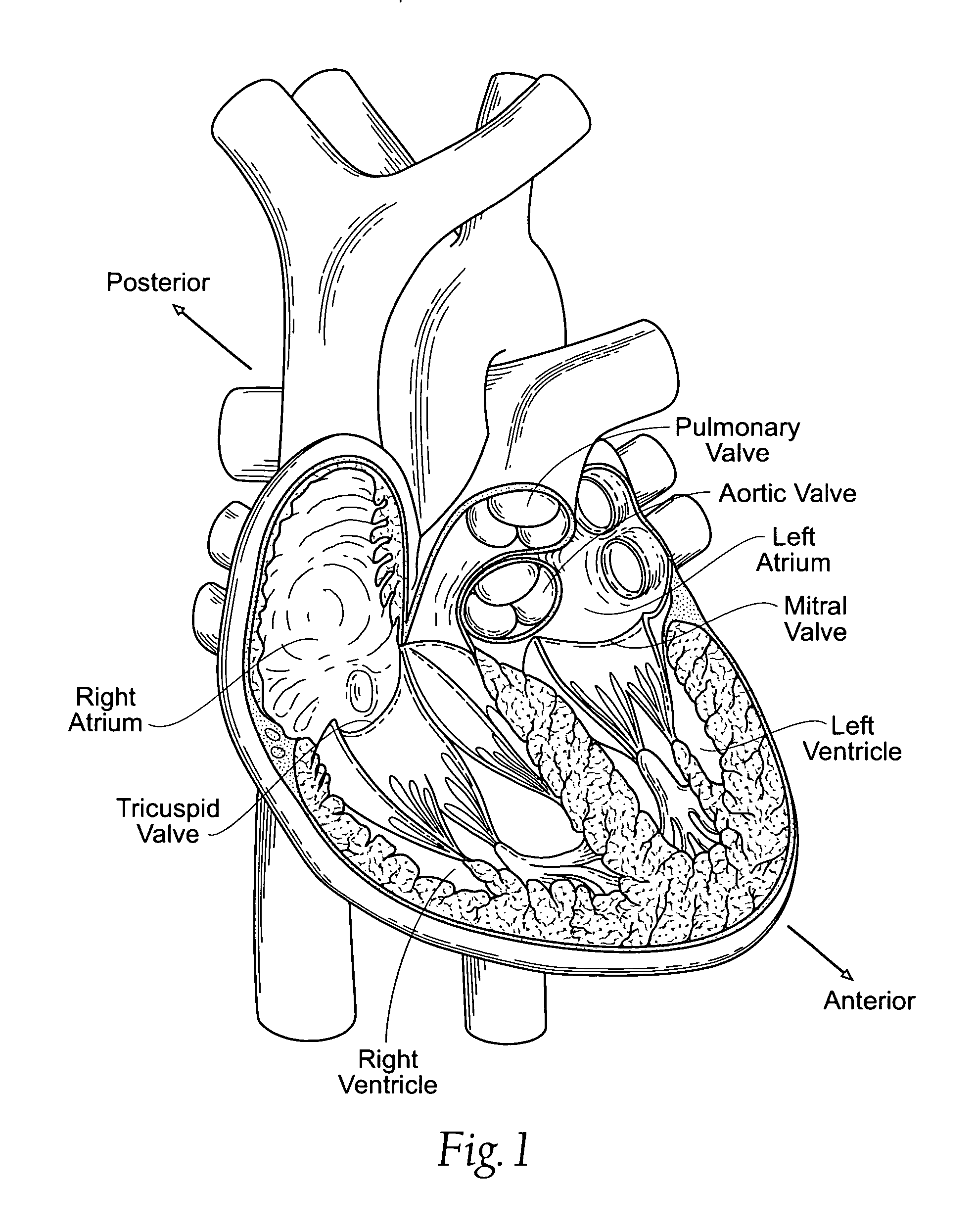 Devices, systems, and methods for reshaping a heat valve annulus