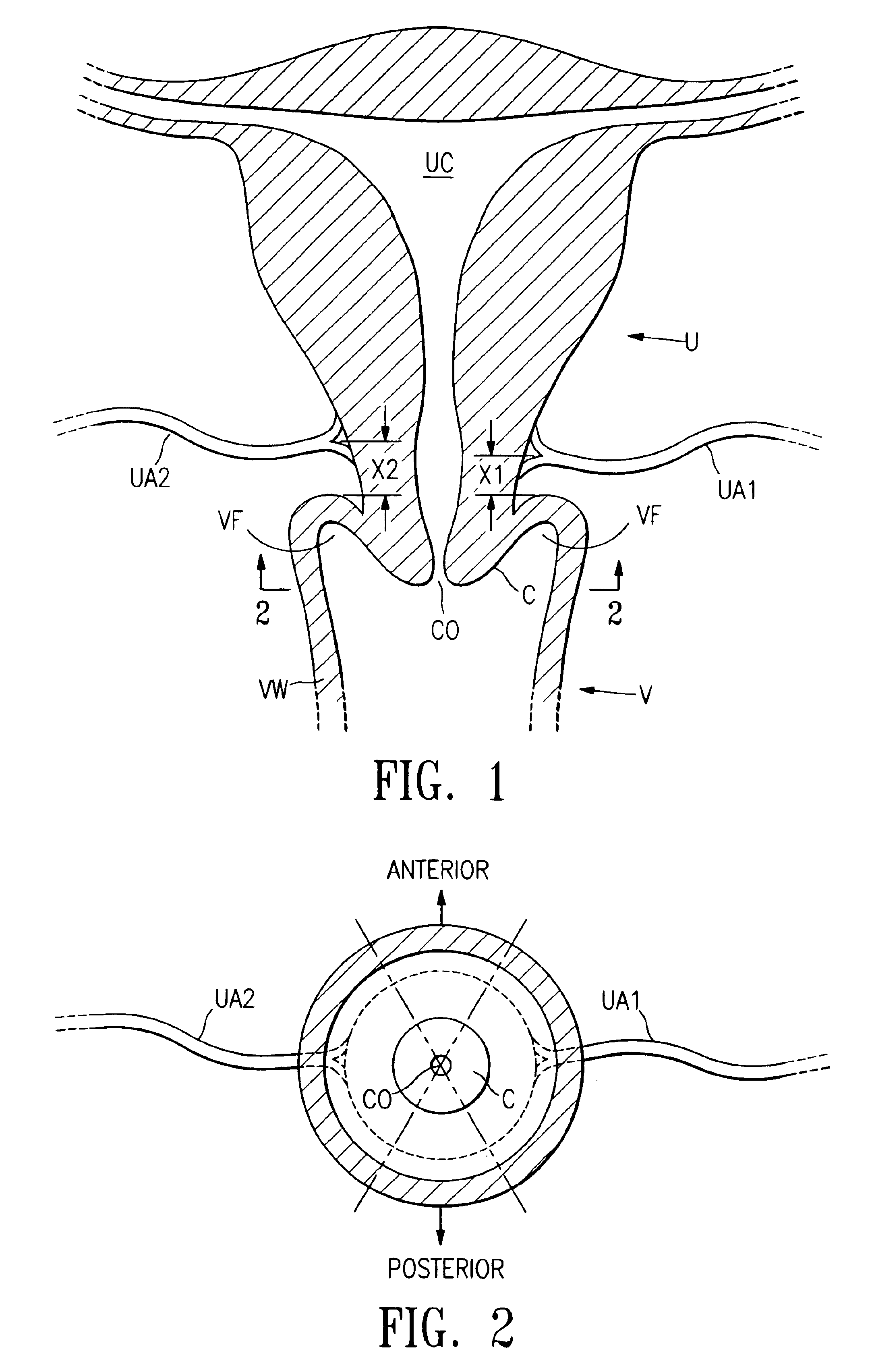 Multi-axial uterine artery identification, characterization, and occlusion pivoting devices and methods