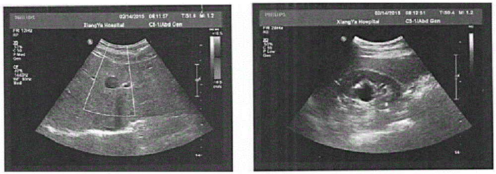 Medicament for treating fatty liver, prostatitis, nephralgia, nephritis, hypertension and diabetes