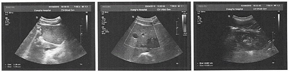 Medicament for treating fatty liver, prostatitis, nephralgia, nephritis, hypertension and diabetes