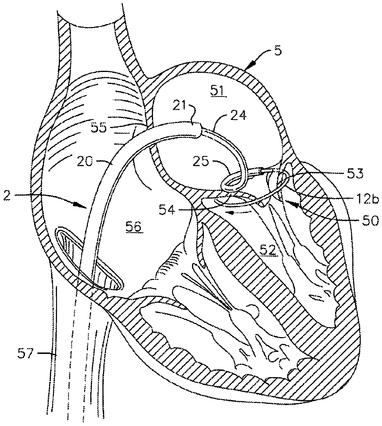 Deployment systems, tools, and methods for delivering an anchoring device for a prosthetic valve