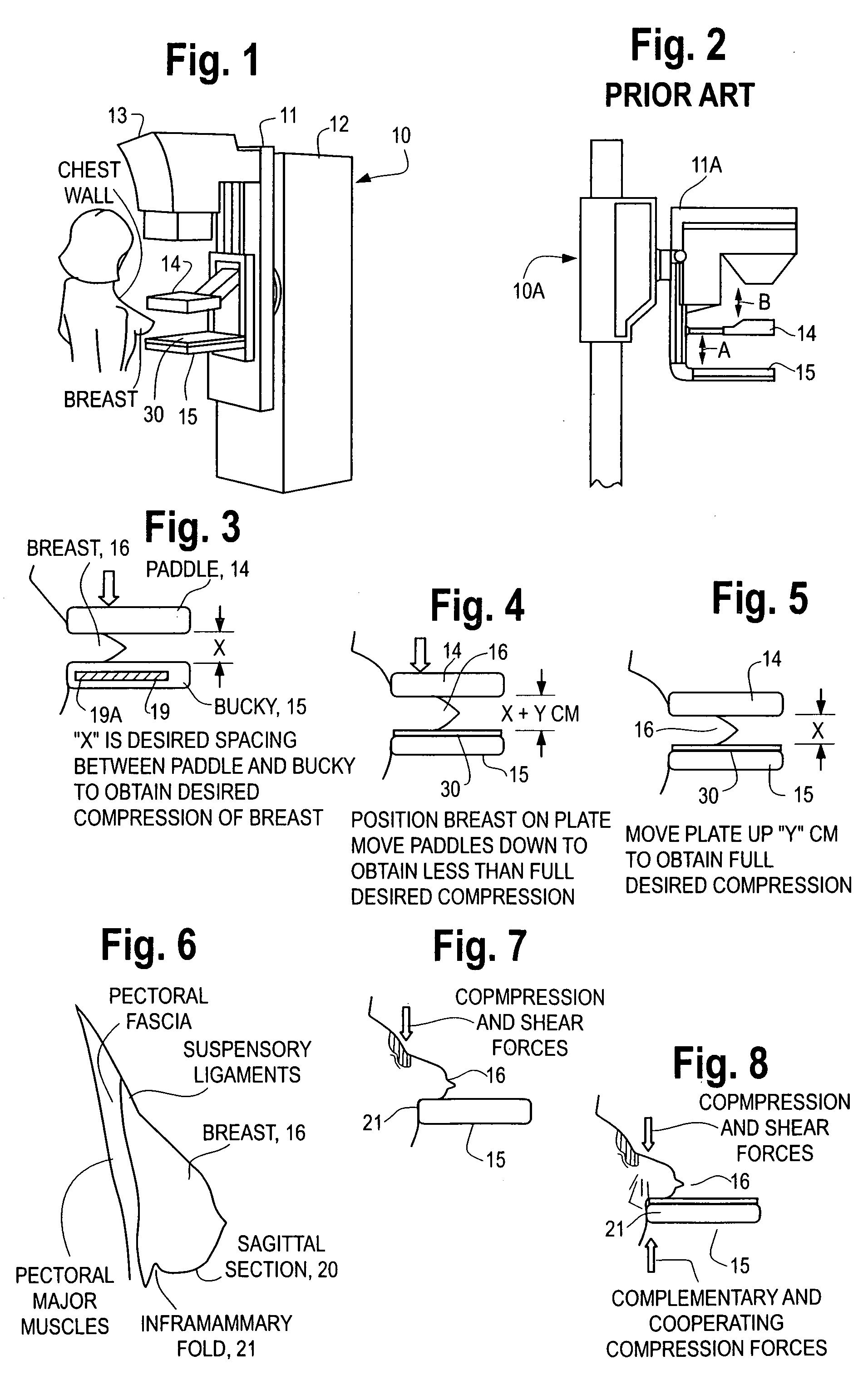 Mammography procedure and apparatus for reducing pain when compressing a breast