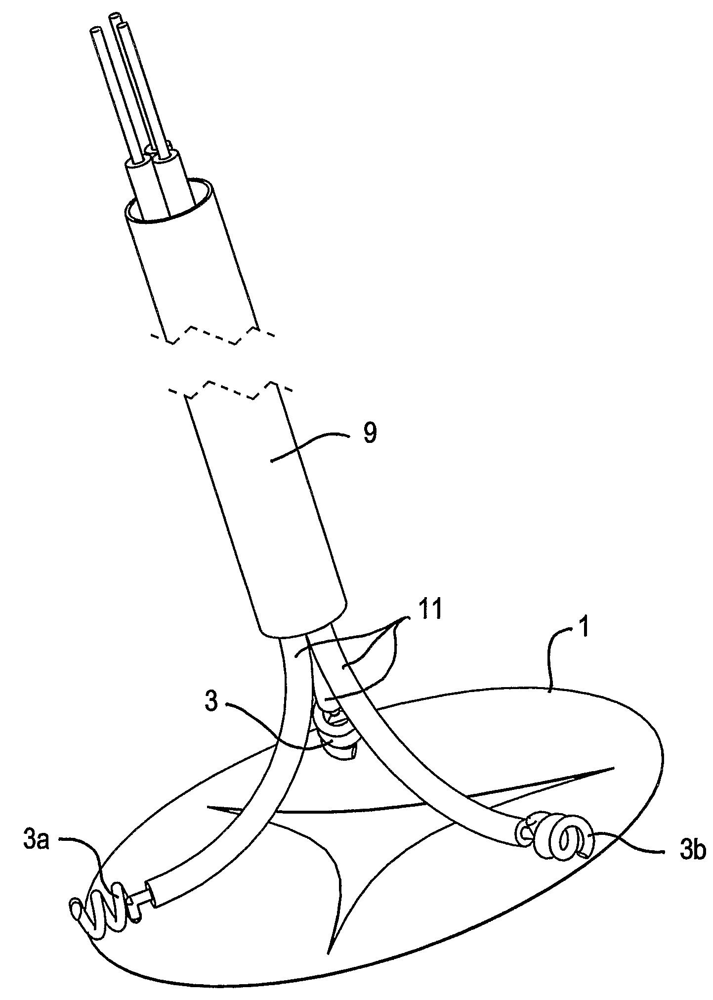 Treating Valvular Insufficiency