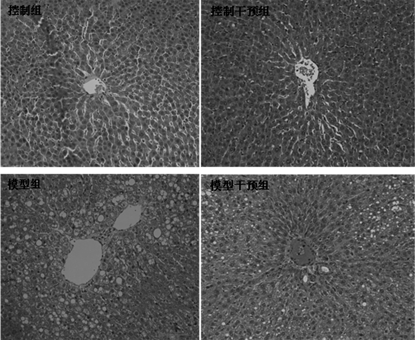 A traditional Chinese medicine composition for treating diabetes complicated with liver fibrosis