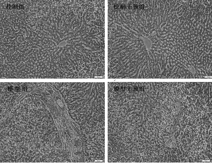 A traditional Chinese medicine composition for treating diabetes complicated with liver fibrosis