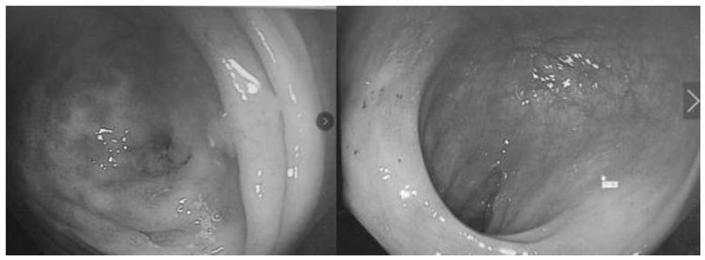 Application of Jian indigo naturalis in preparation of medicine for treating ulcerative colitis