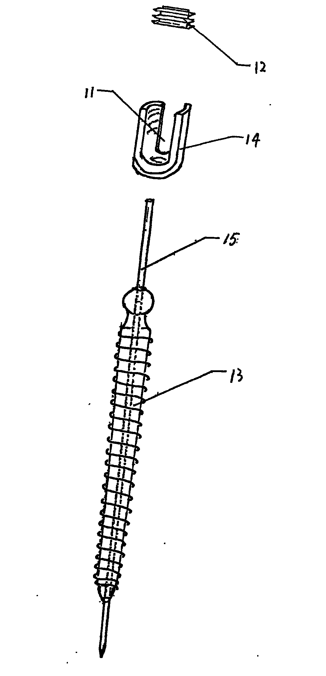 Lumbar spondylolysis restoration internal fixation system