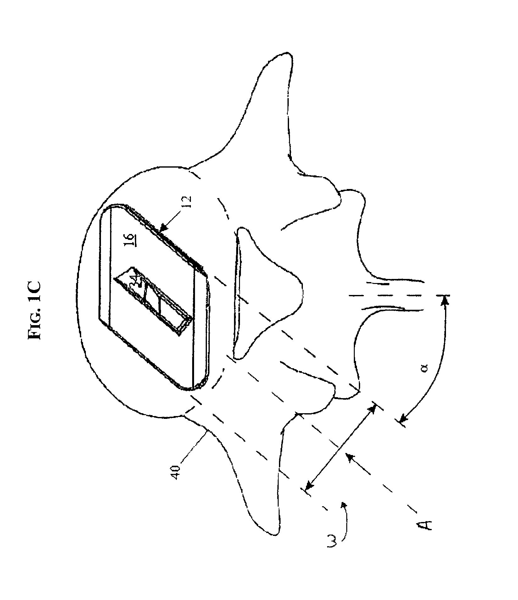 Artificial Disc Replacement Using Posterior Approach